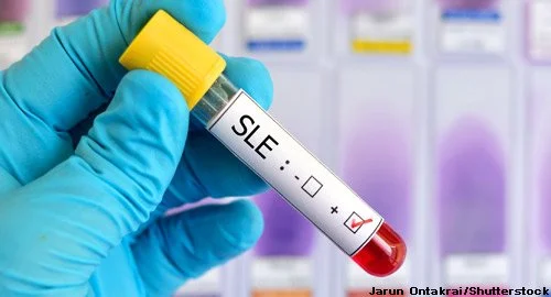 EBV and Lupus: Stanford’s “Breakthrough” or Long-Overdue Validation?