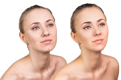 Side-by-side comparison of a woman before and after skincare treatment, showing improved skin clarity and texture.