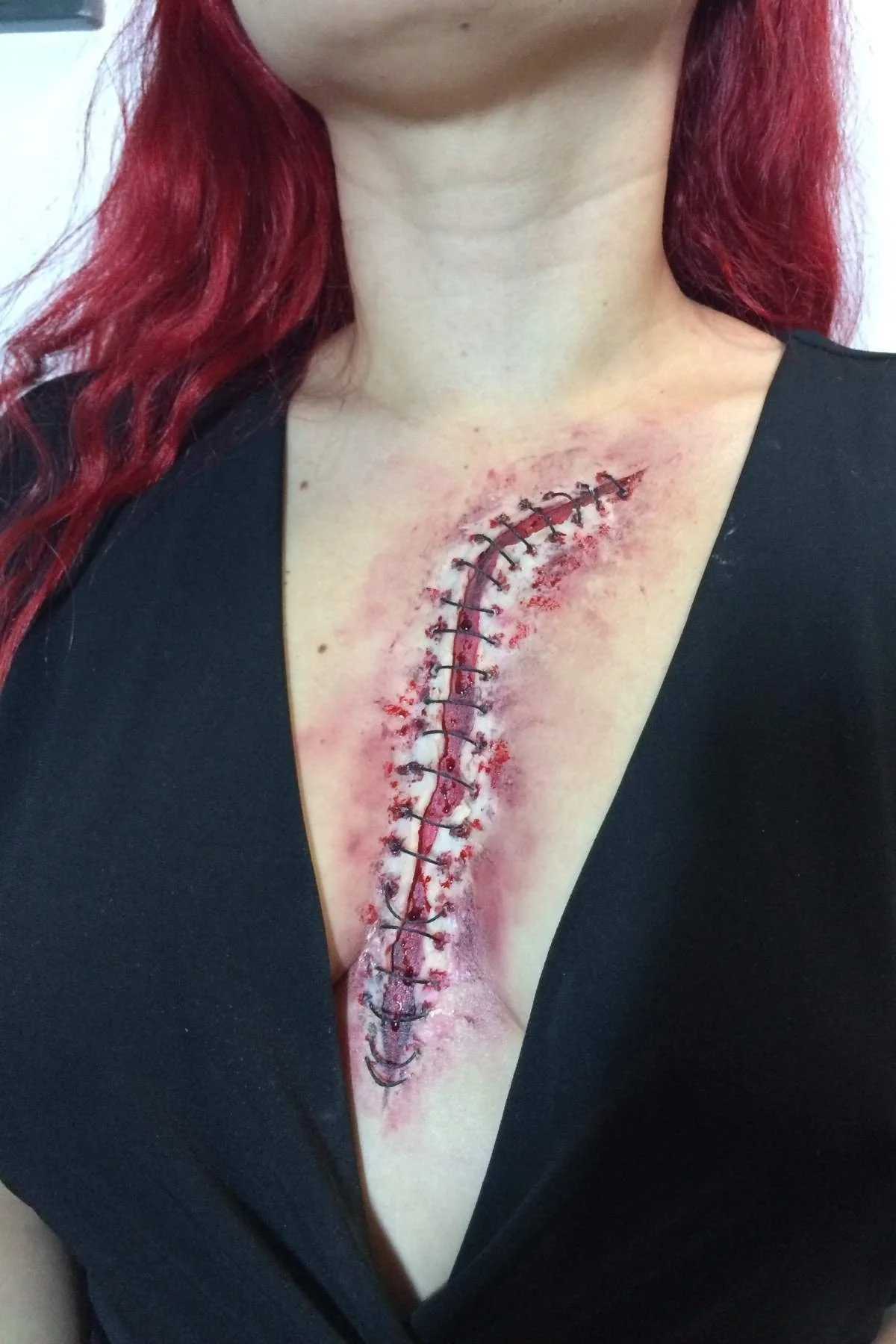 A person's chest with a large, fresh surgical scar from a recent chest surgery, featuring staples and redness around the incision.