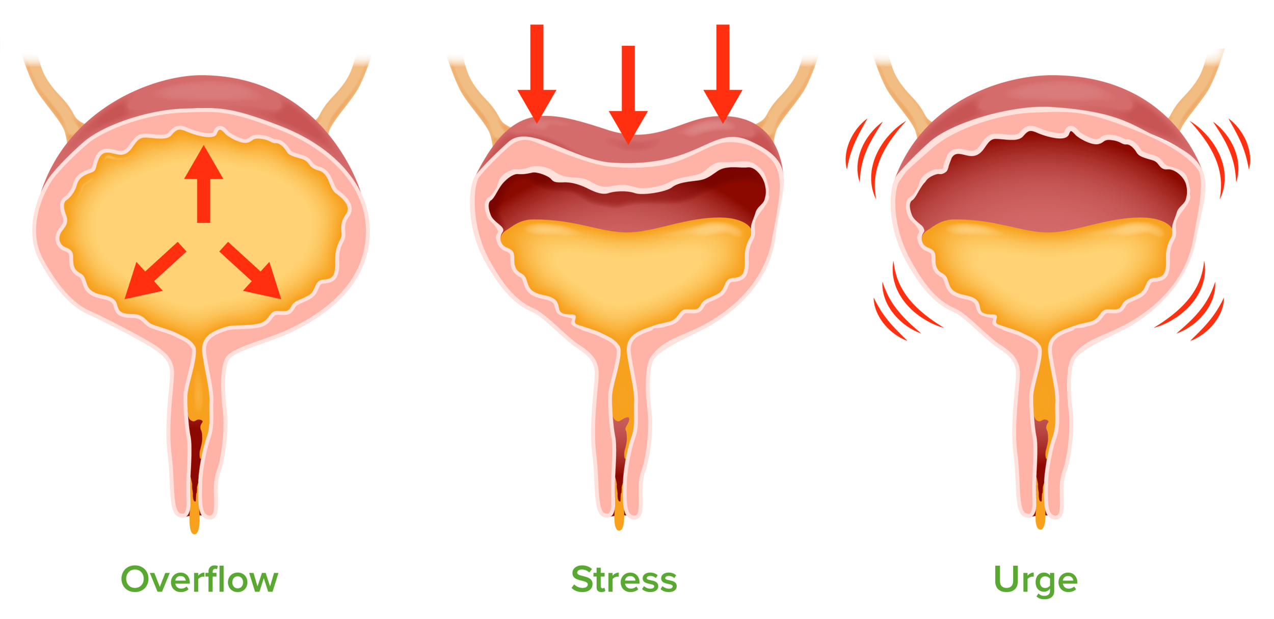 Explanation of different types of urinary incontinence