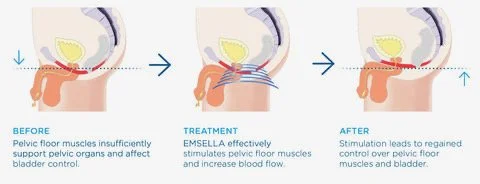 Diagram showing treatment for bladder control issues: before image shows weak pelvic floor muscles, middle image shows effective stimulation increasing blood flow, after image shows improved bladder control.