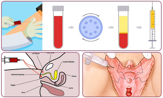 Visual of what to expect during an O-shot procedure