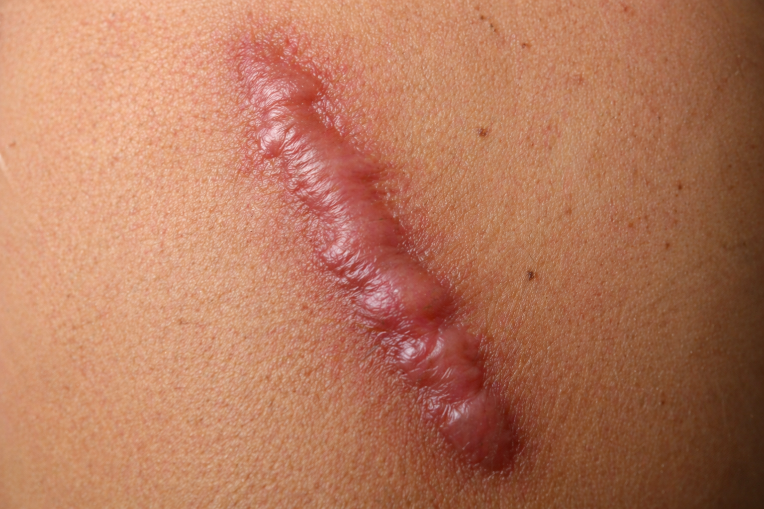 traitement-cicatrice-hypertrophique-lyon