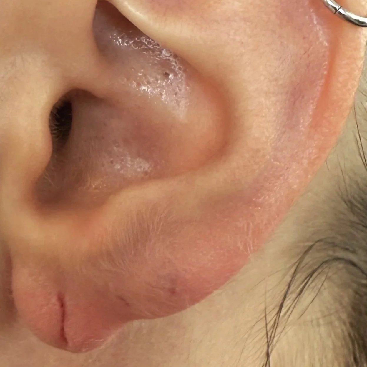 réparer lobe oreille fendu lyon