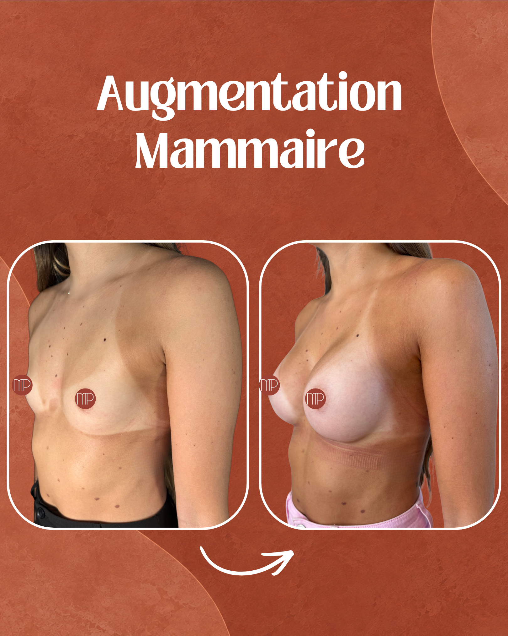 avant-après-augmentation-mammaire-lyon