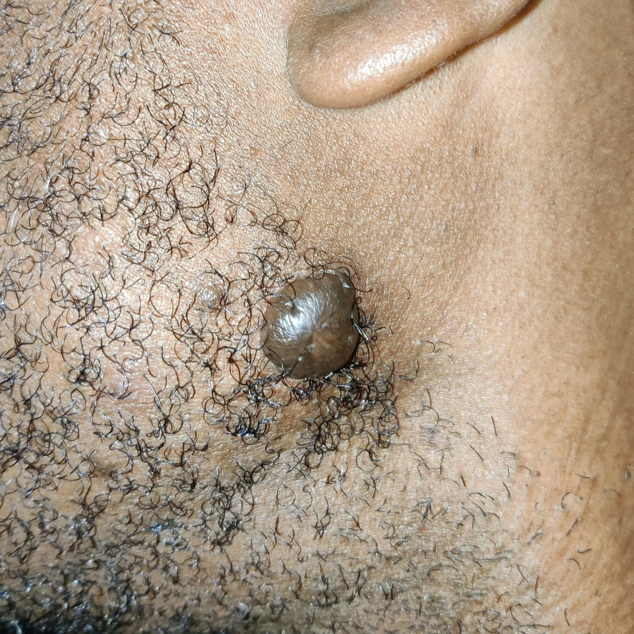 traitement cicatrices chéloïdes