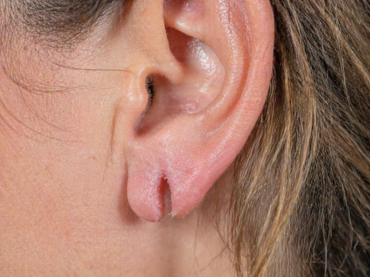 lobe-oreille-fendu-lyon