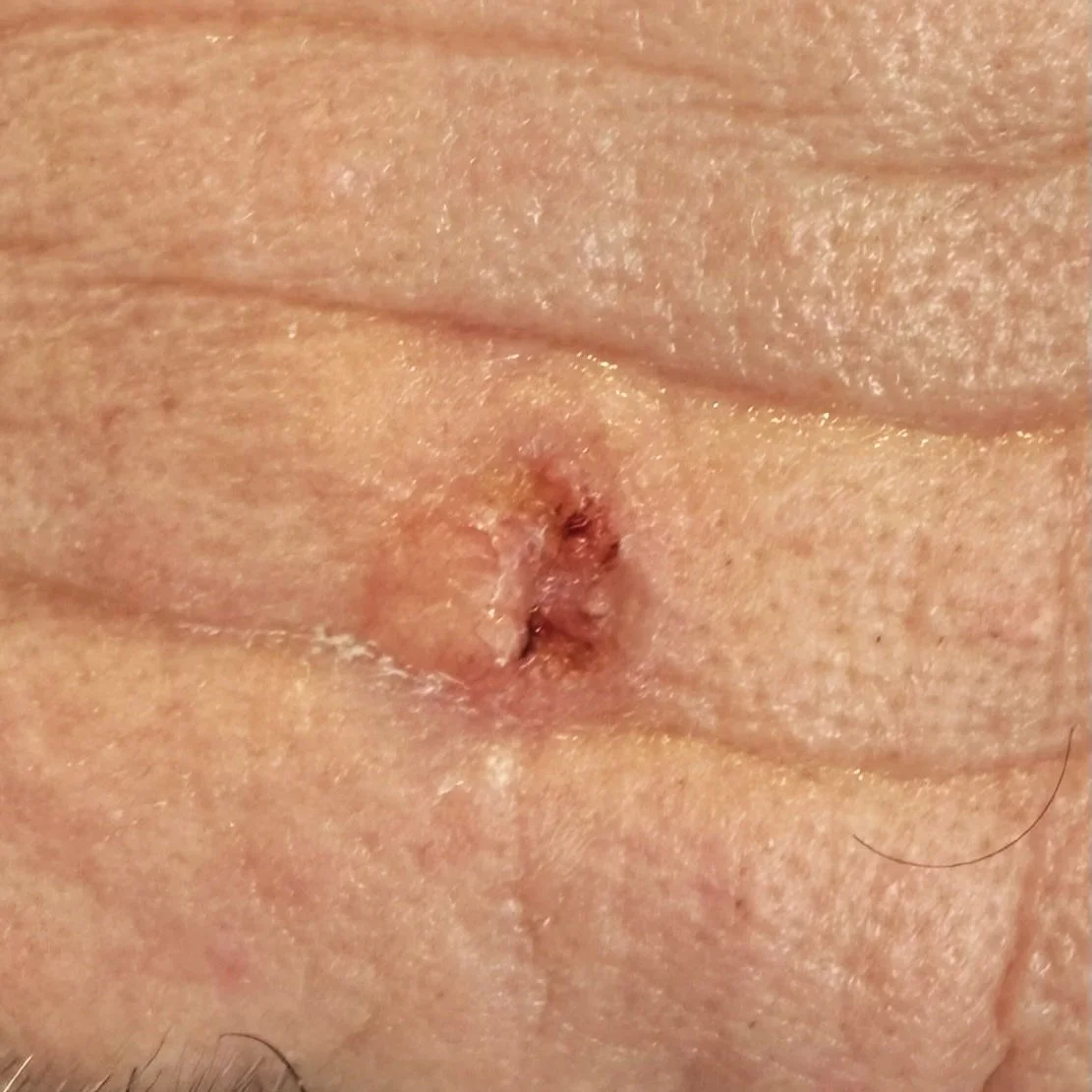 Retirer cancer de la peau