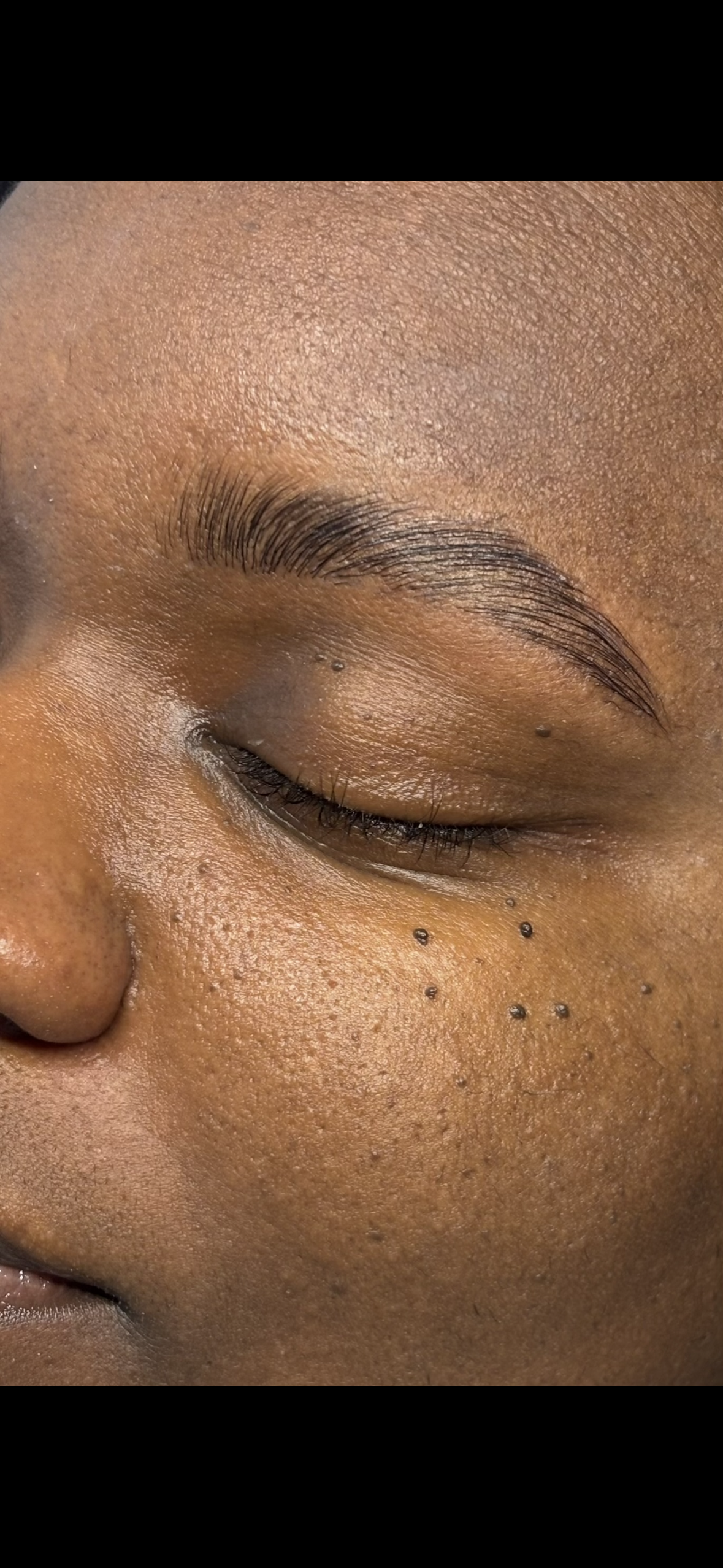 Close-up of a person's face with freshly done eyebrow microblading, closed eye, and small black moles on cheek.