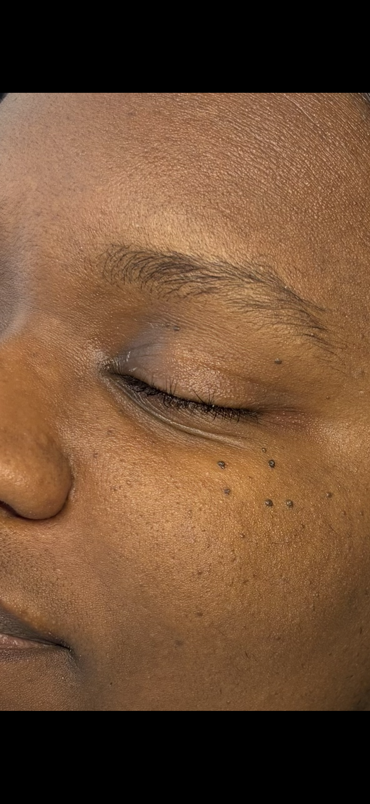 Close-up of a person's face with skin dots or moles near the eye.