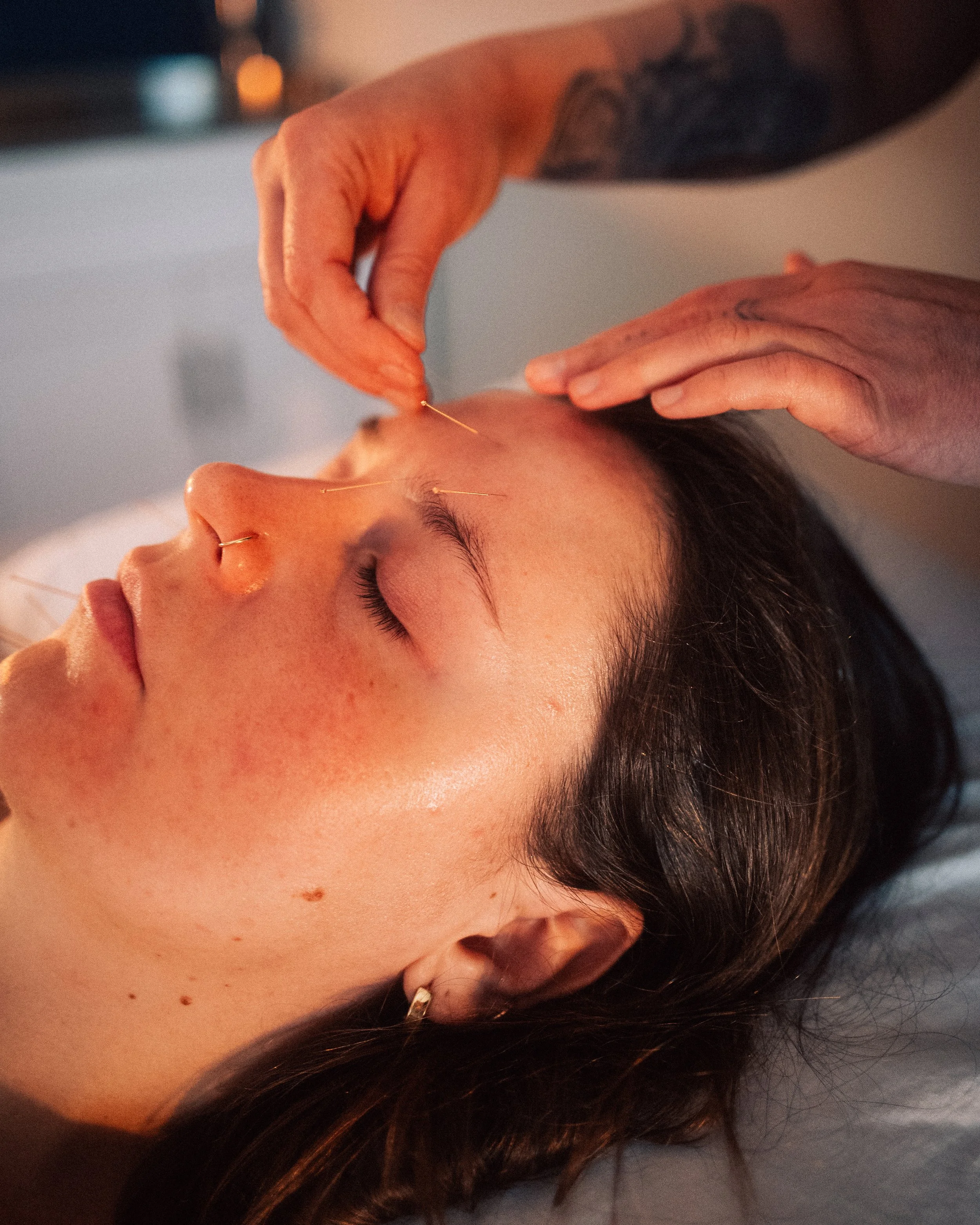 Cosmetic Acupuncture (Mei Rong) | Natural Facial Rejuvenation in Calgary