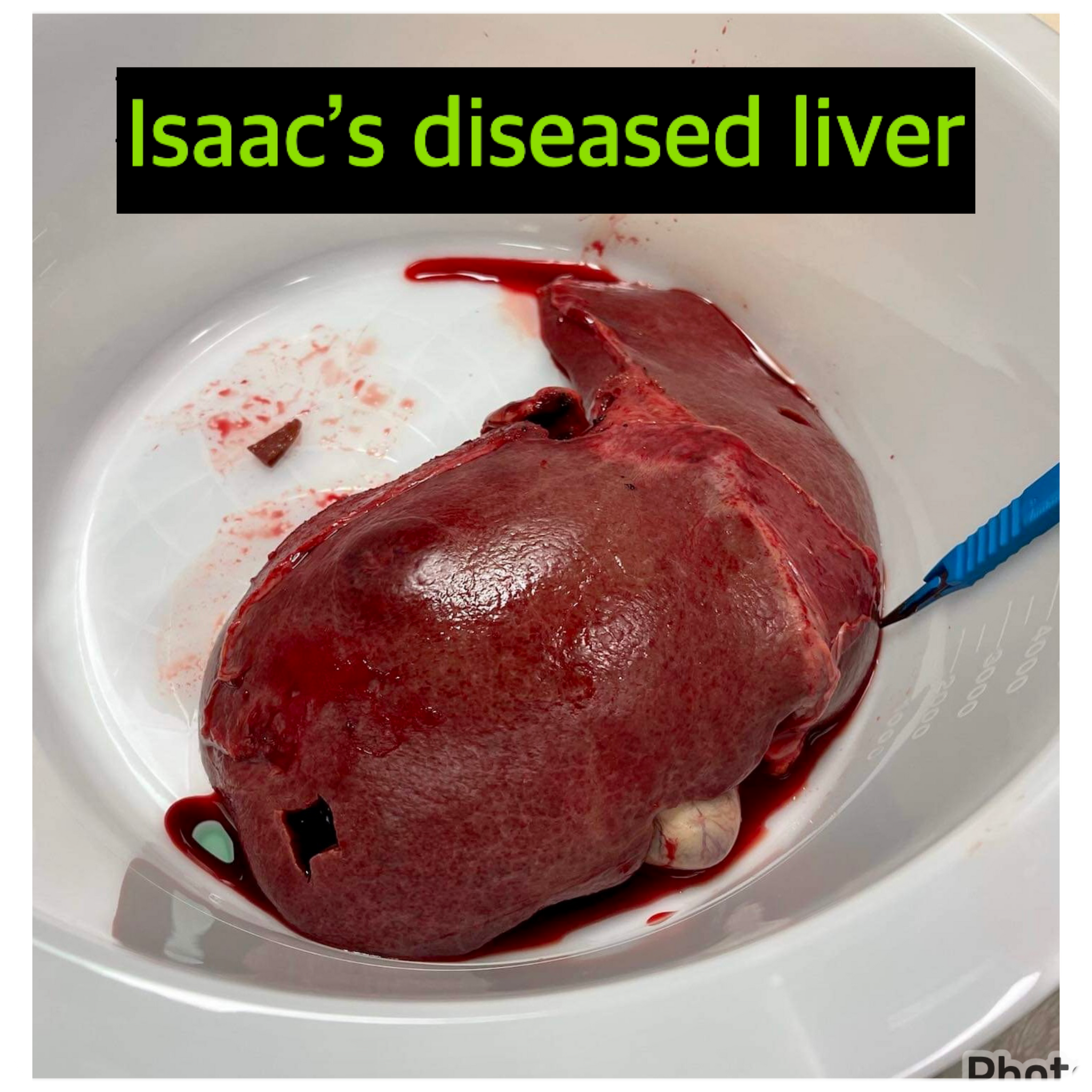 Isaac's diseased liver