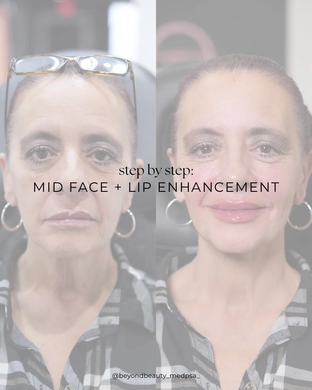 As we age, the mid-face is one of the first areas to show structural change. 

We naturally lose volume in the deep fat pads, experience gradual collagen decline, and even subtle bone resorption - all of which contribute to flattening in the cheeks a