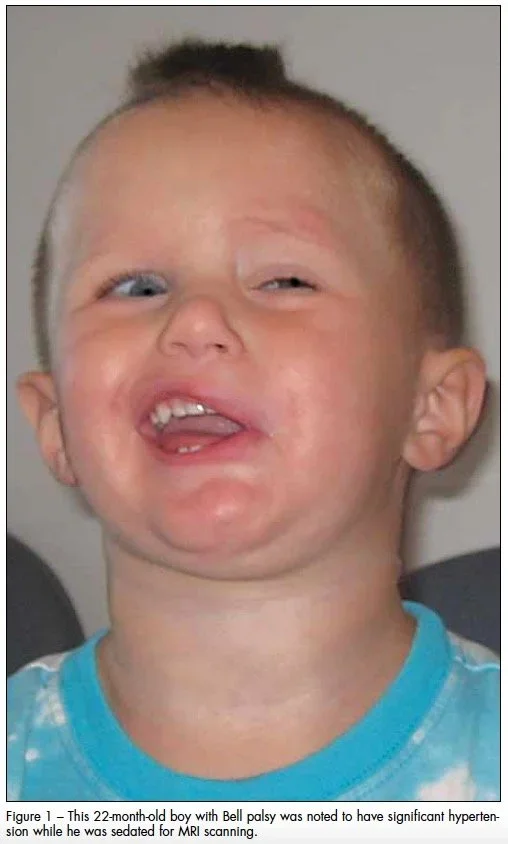 Bài tập vật lý trị liệu &amp; massage mặtcho trẻ liệt VII ngoại biên