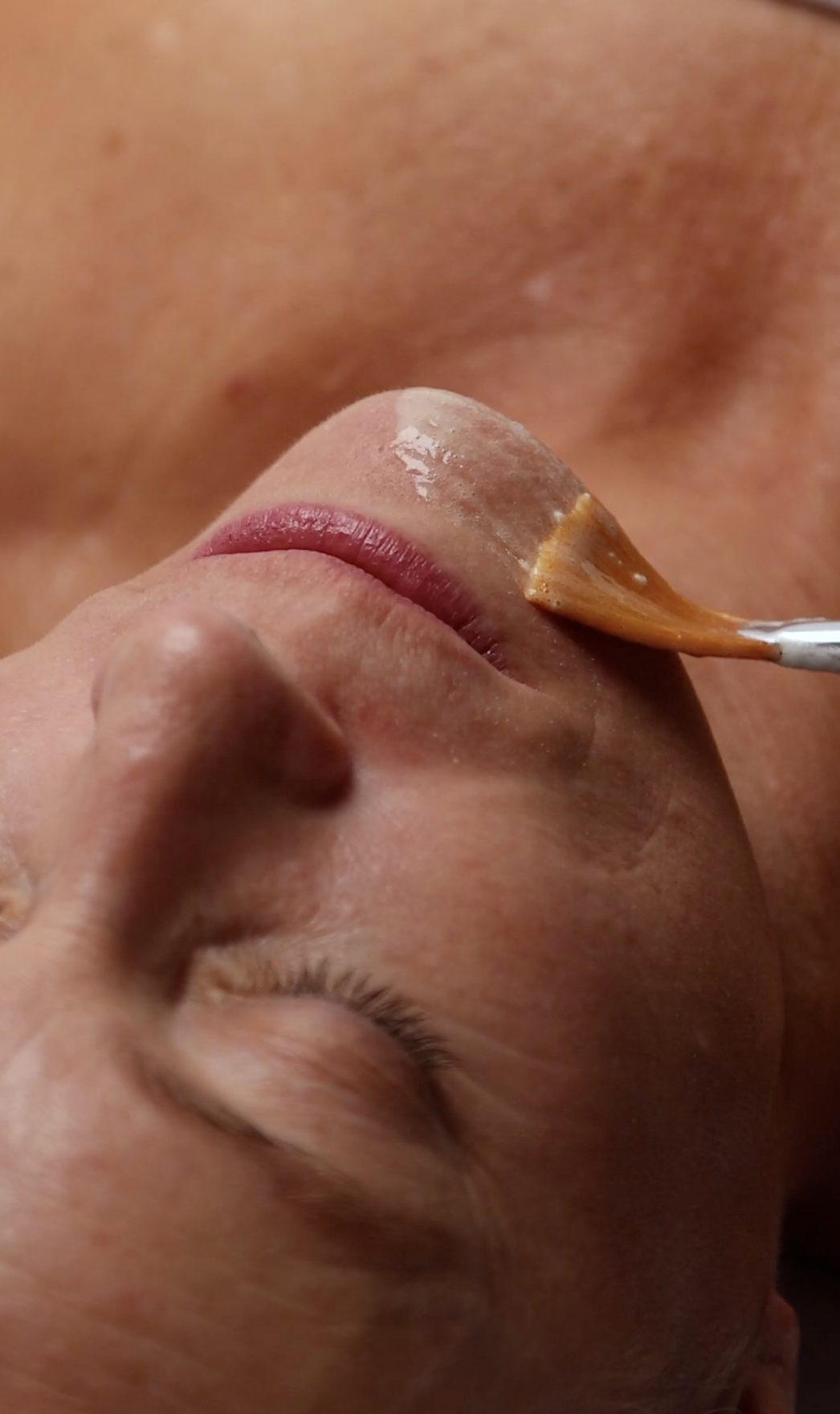 Chemical peel treatment for fairer skin tones at Unforgotten Skin Bristol