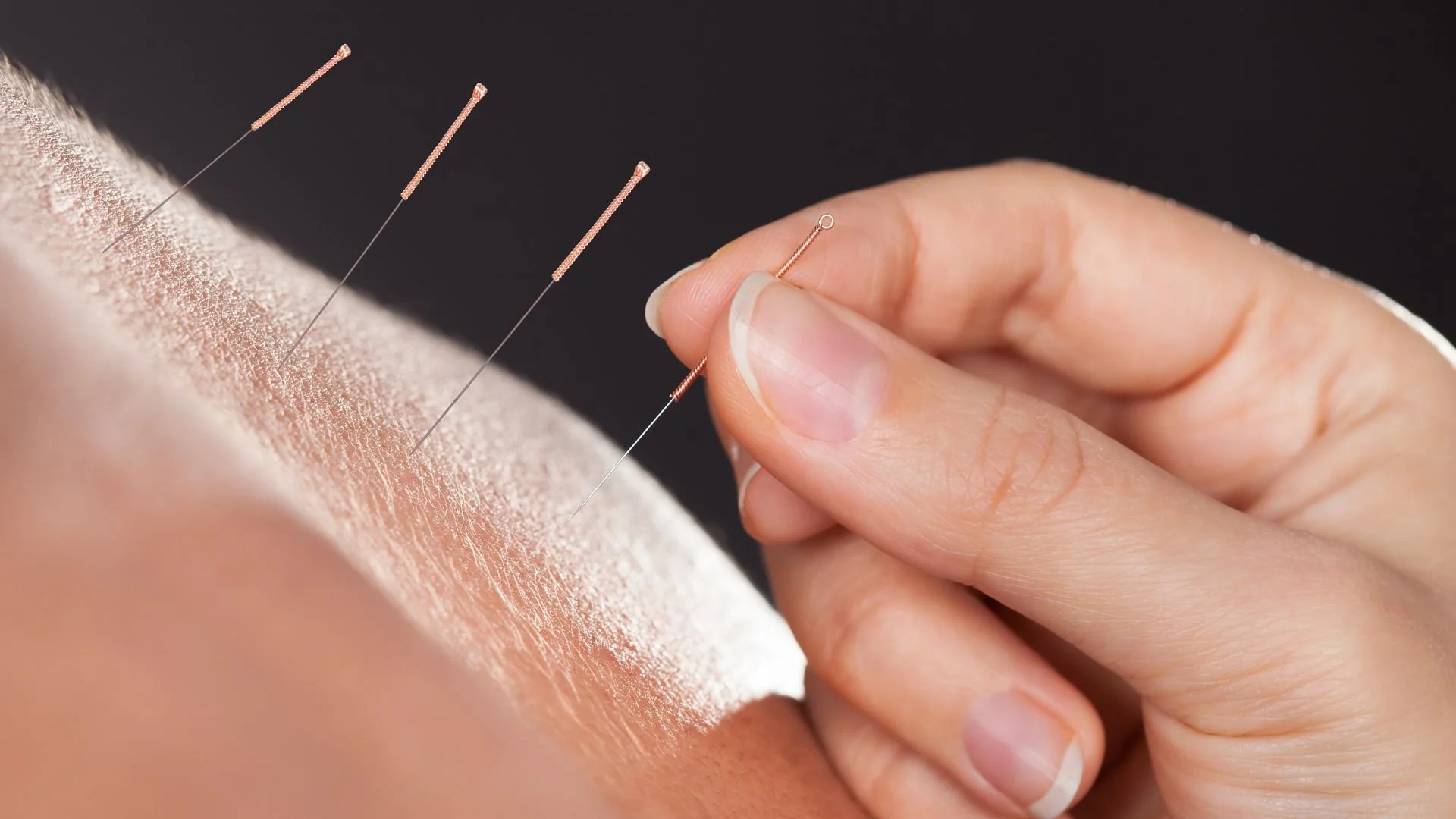 Acupuncture in Brentwood: Pain Relief and Better Movement