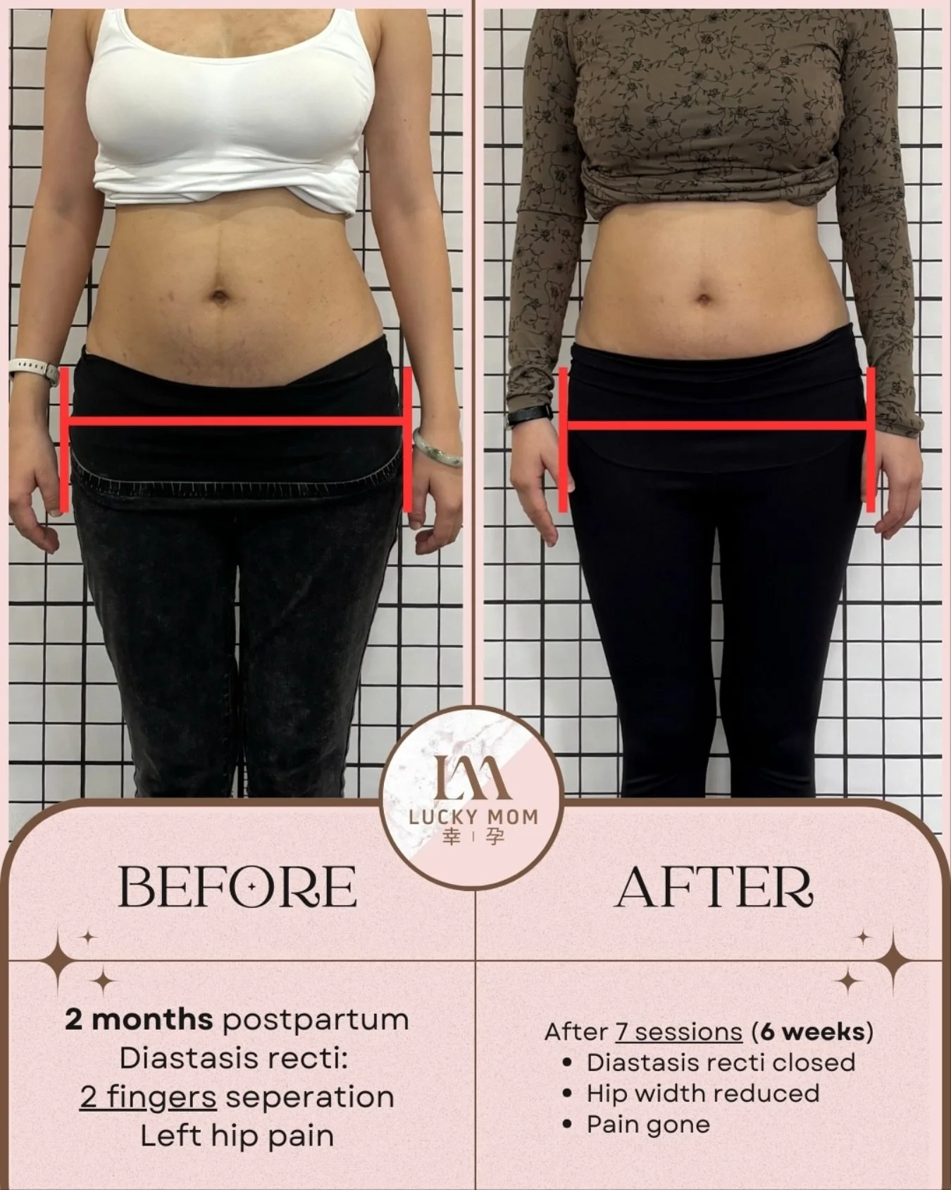 ✨ Goodbye diastasis &amp; hip pain, hello balance &amp; strength 💪 

This mama came to us 2 months postpartum with 2-finger diastasis recti and painful hip discomfort.

After just 7 customized sessions in 6 weeks &mdash; including fascia therapy, pr