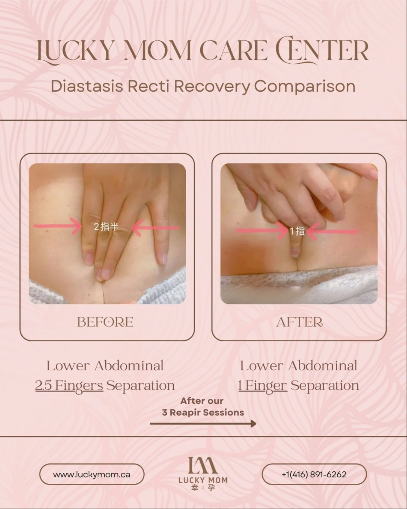 ✨ Lower Abdominal Separation Recovery ✨
This mama came to us 3 months postpartum with a 2.5-finger separation and mild back pain.

After just 3 personalized sessions &mdash; including fascia massage, private Pilates, and bio-electric therapy &mdash; 