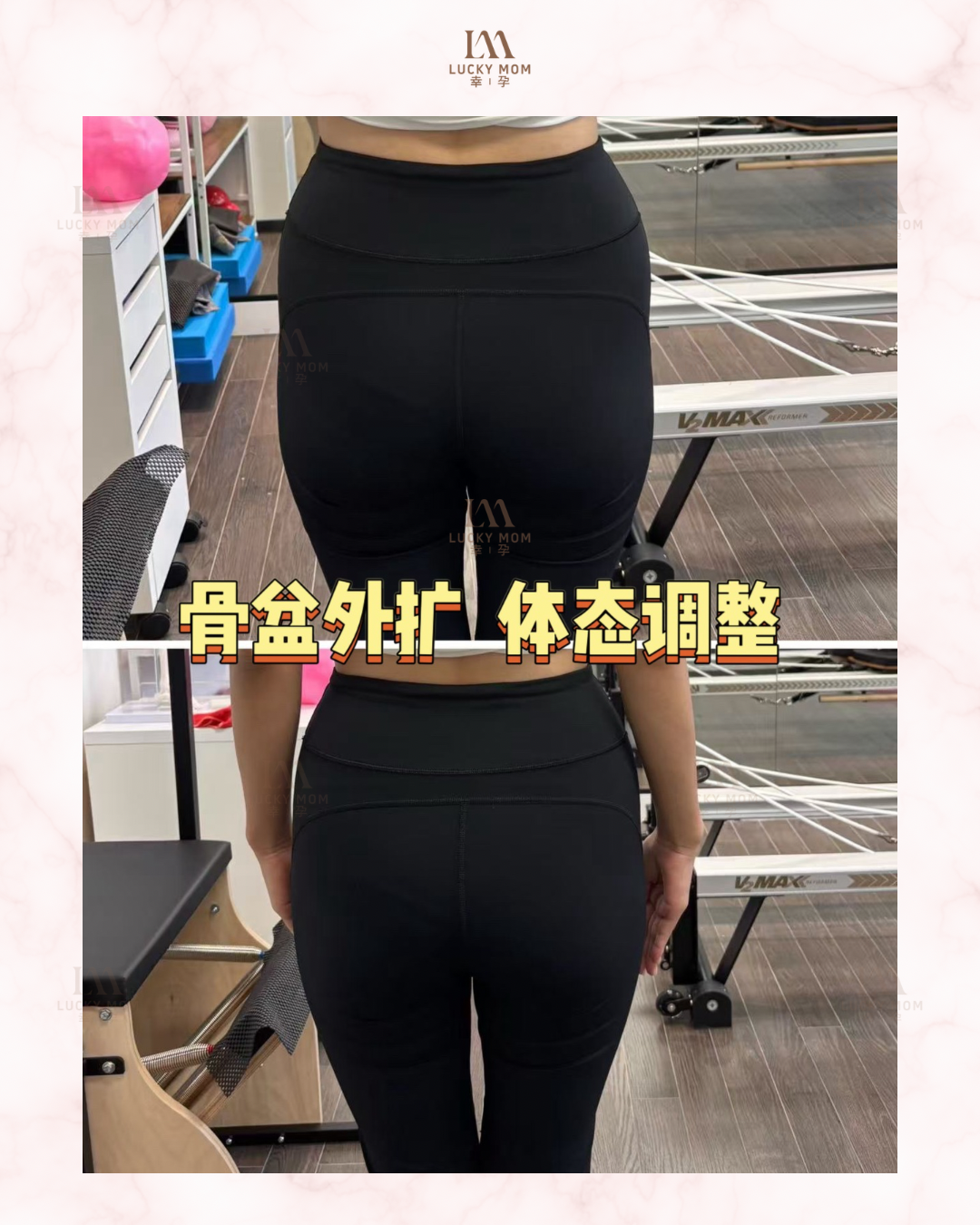 案例：产后骨盆外扩调整