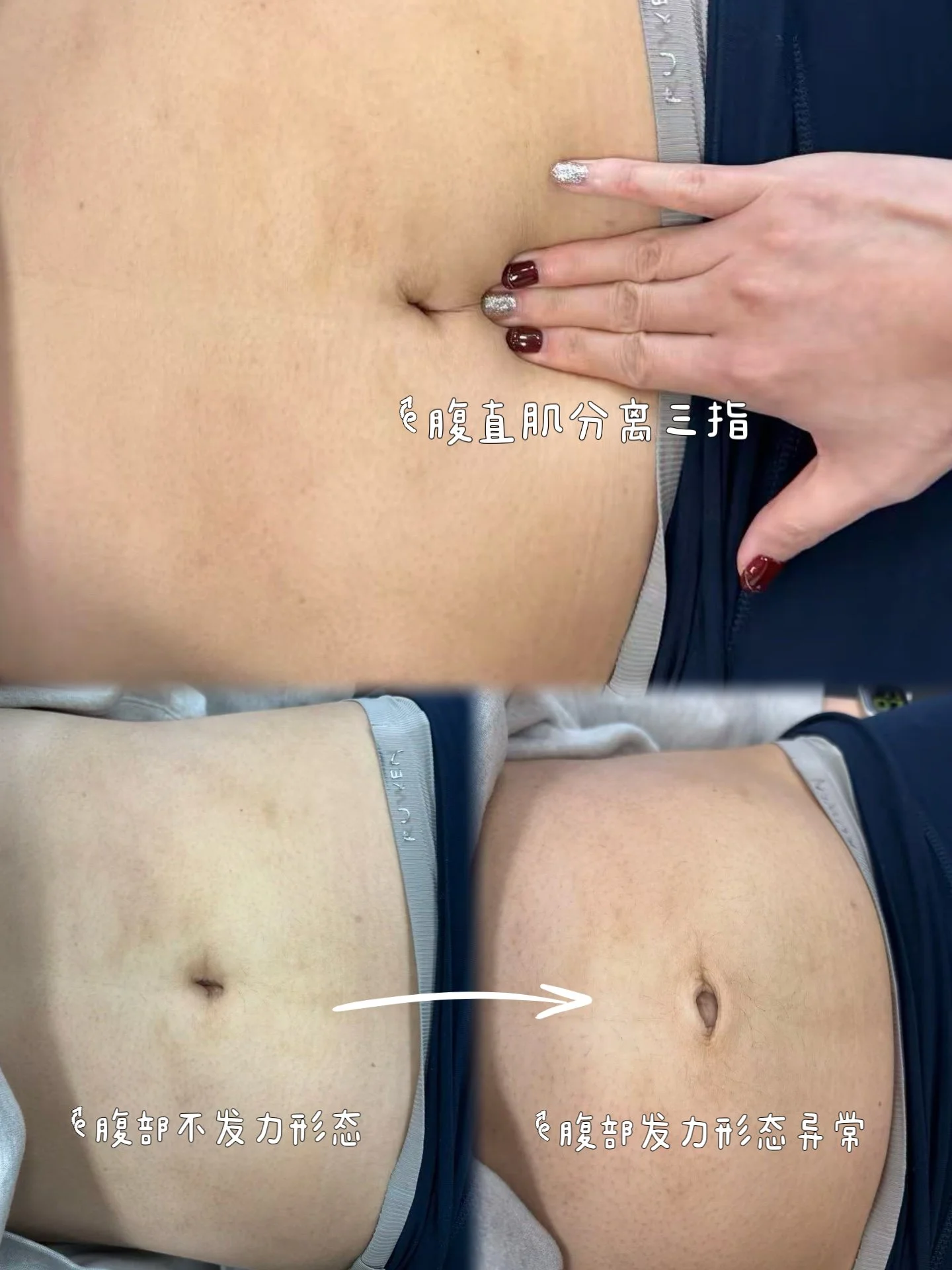 腹直肌分离案例