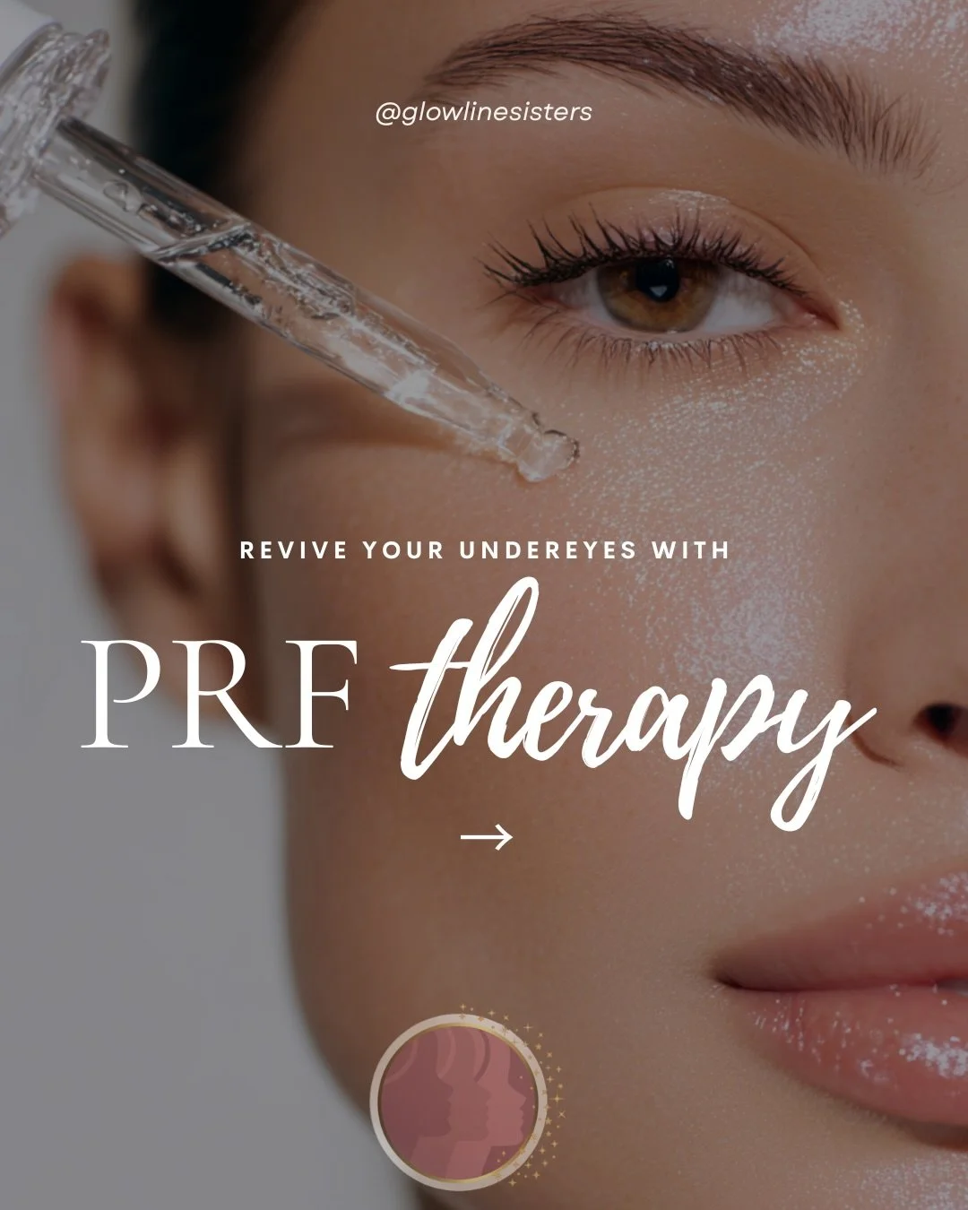 Here&rsquo;s what actually happens during under-eye PRF 👁️

Your own platelets get activated and reinjected to help refresh tired, hollow areas

No filler&mdash;just your body&rsquo;s natural growth factors working to improve texture and tone over t