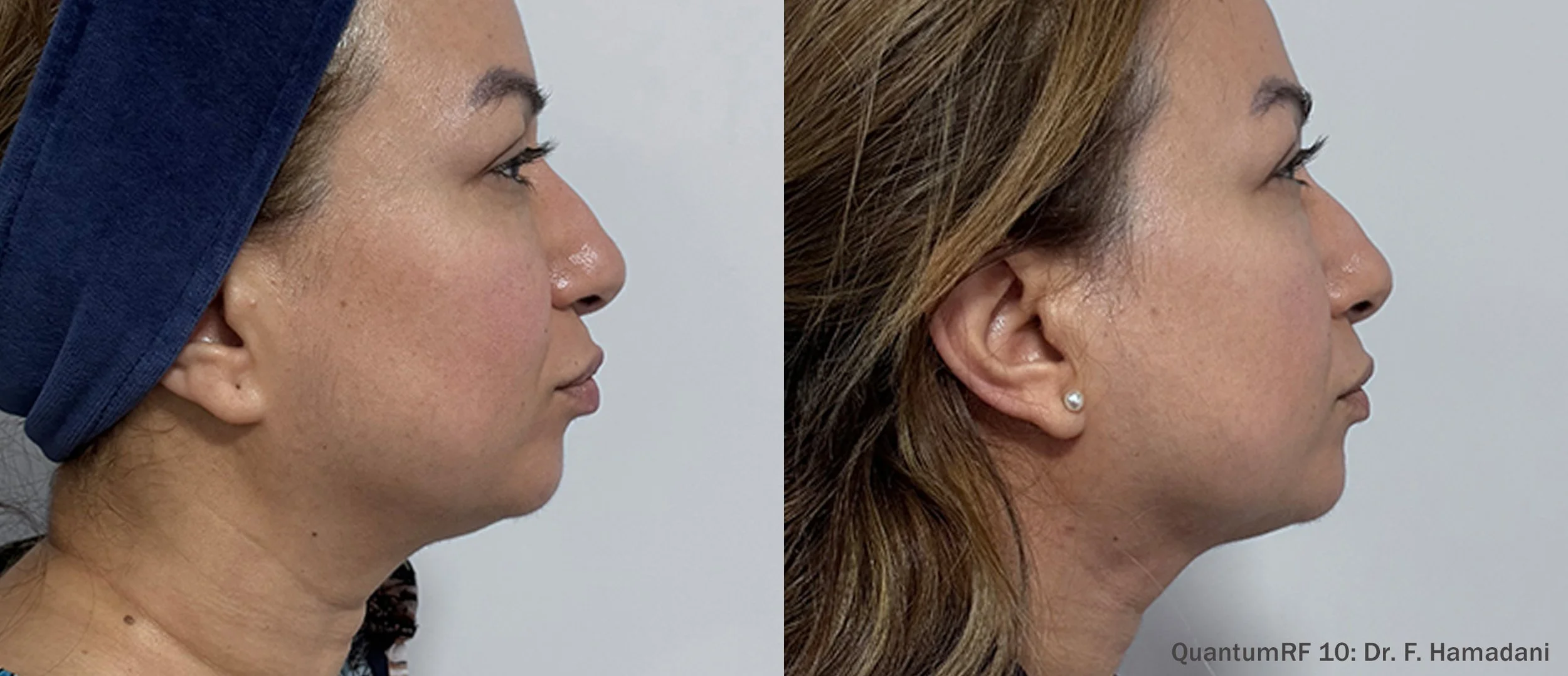 Quantum RF Skin Tightening in Orland Park, IL: Advanced Non-Surgical Skin Rejuvenation
