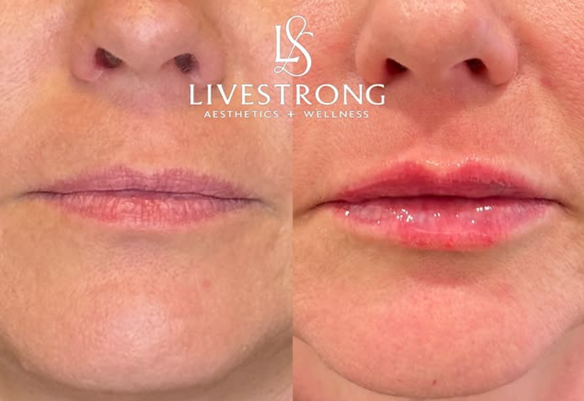 The Perfect LiveStrong Lips: Achieve Your Dream Lip Refresh in Orland Park, IL
