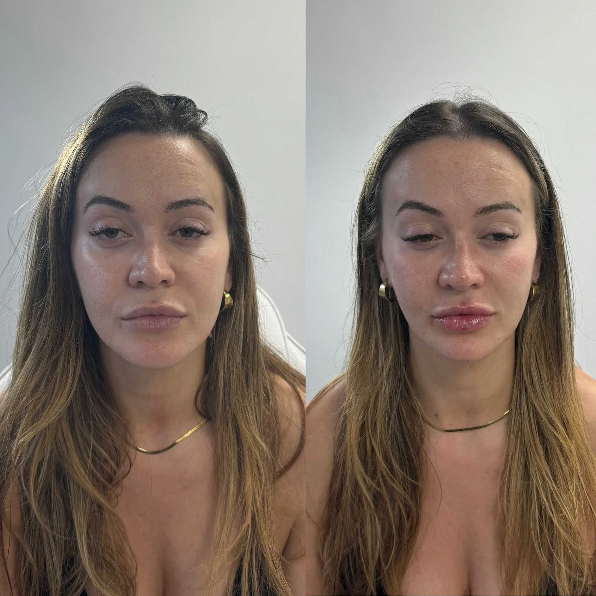 Full face beautification treatment with Dermal fillers at UKALM using 3mL Dermal Fillers in Lips, chin & Cheeks.