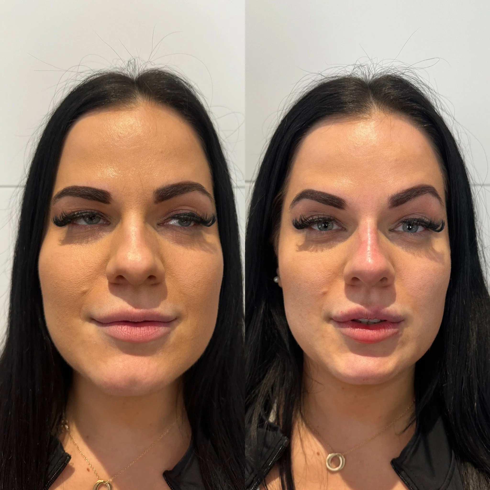 Beautification with Dermal Filler of the Nose & Chin in addition to Lip filler to feminise a masculine face. 3mLs of Dermal Filler package