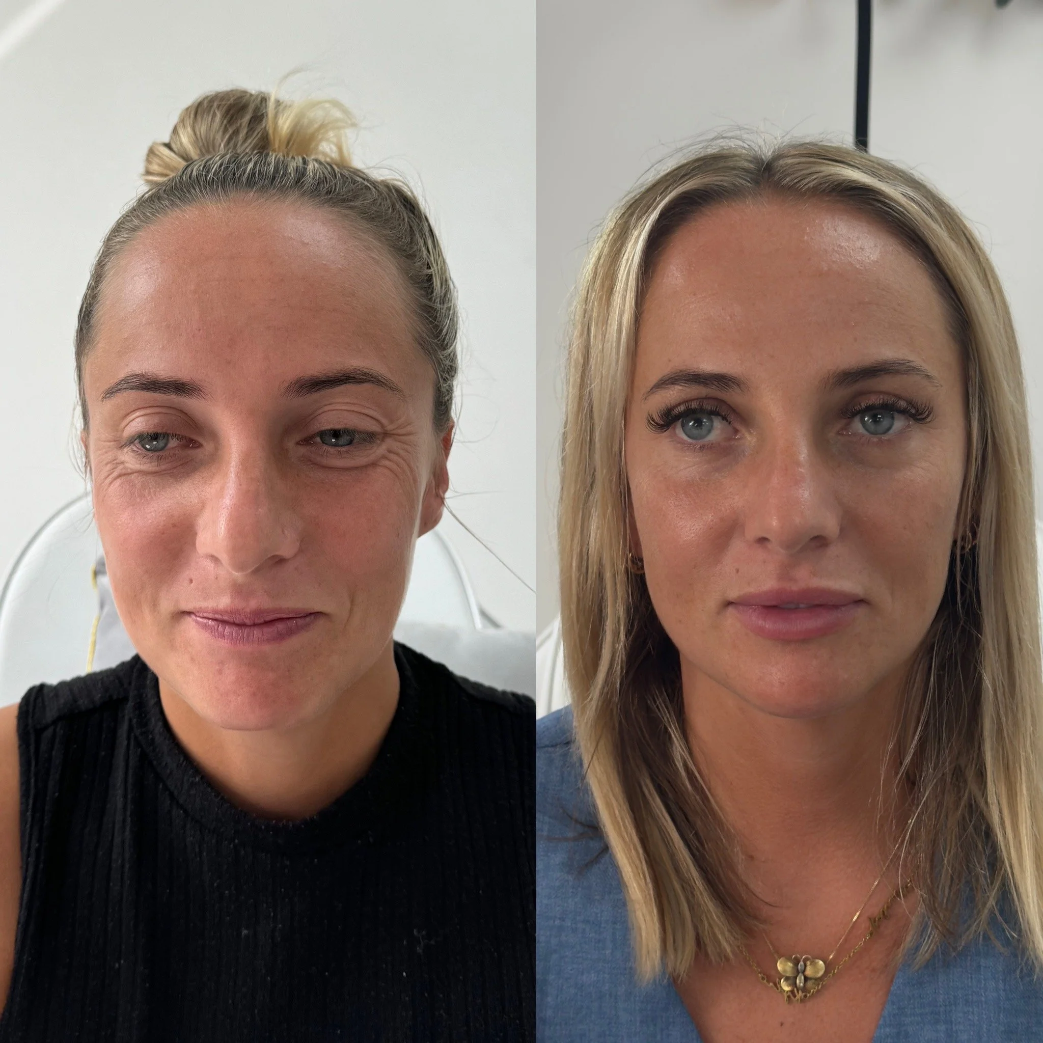 Beautification and Barbie-makeover treatment at UKALM, Dermal Fillers specialists. The best Dermal Filler treatment & best Aesthetics Clinic in London.