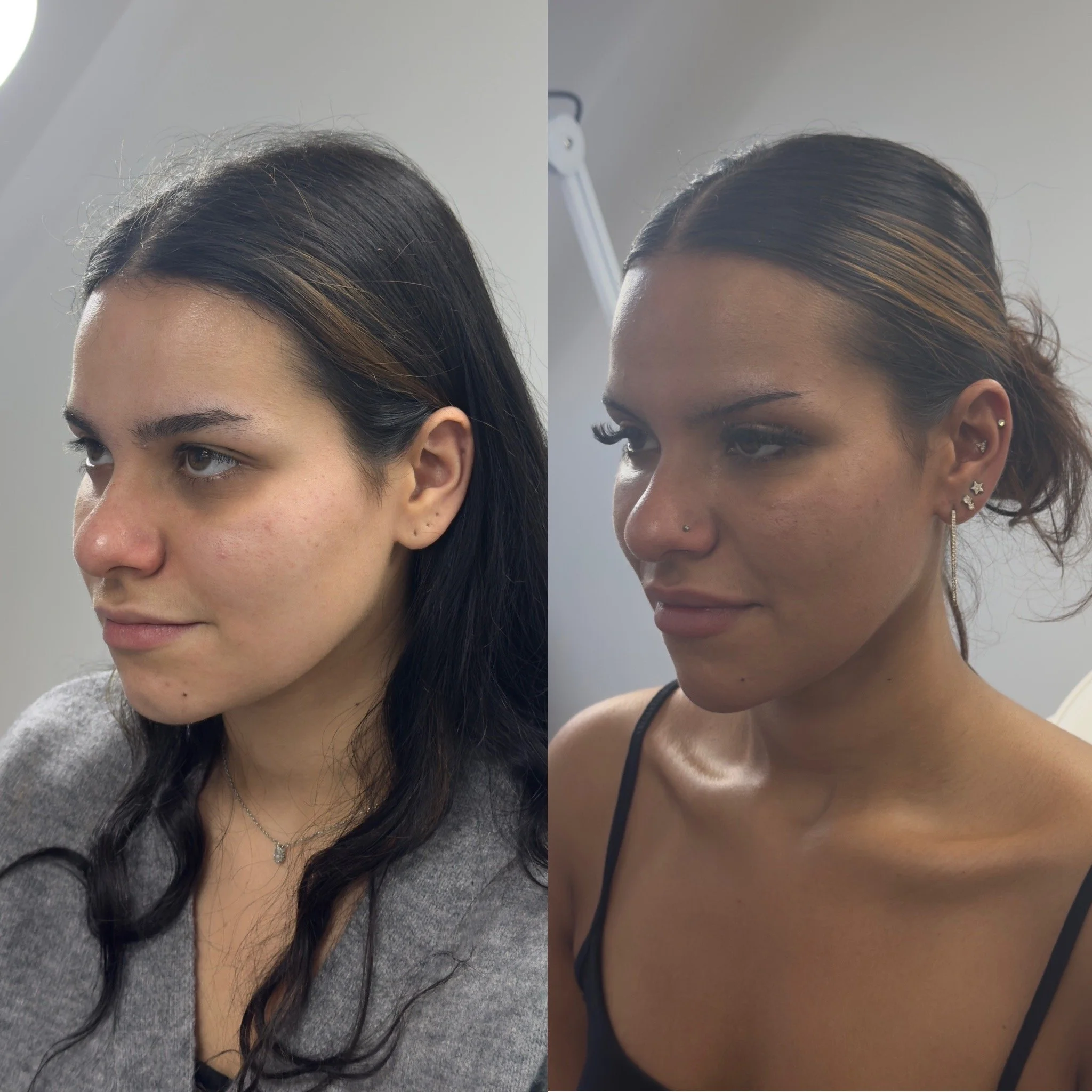 Profilng and Harmonization treatment at UKALM, Dermal Filler specialists. The best Dermal Filler treatment & best Aesthetics Clinic in London.