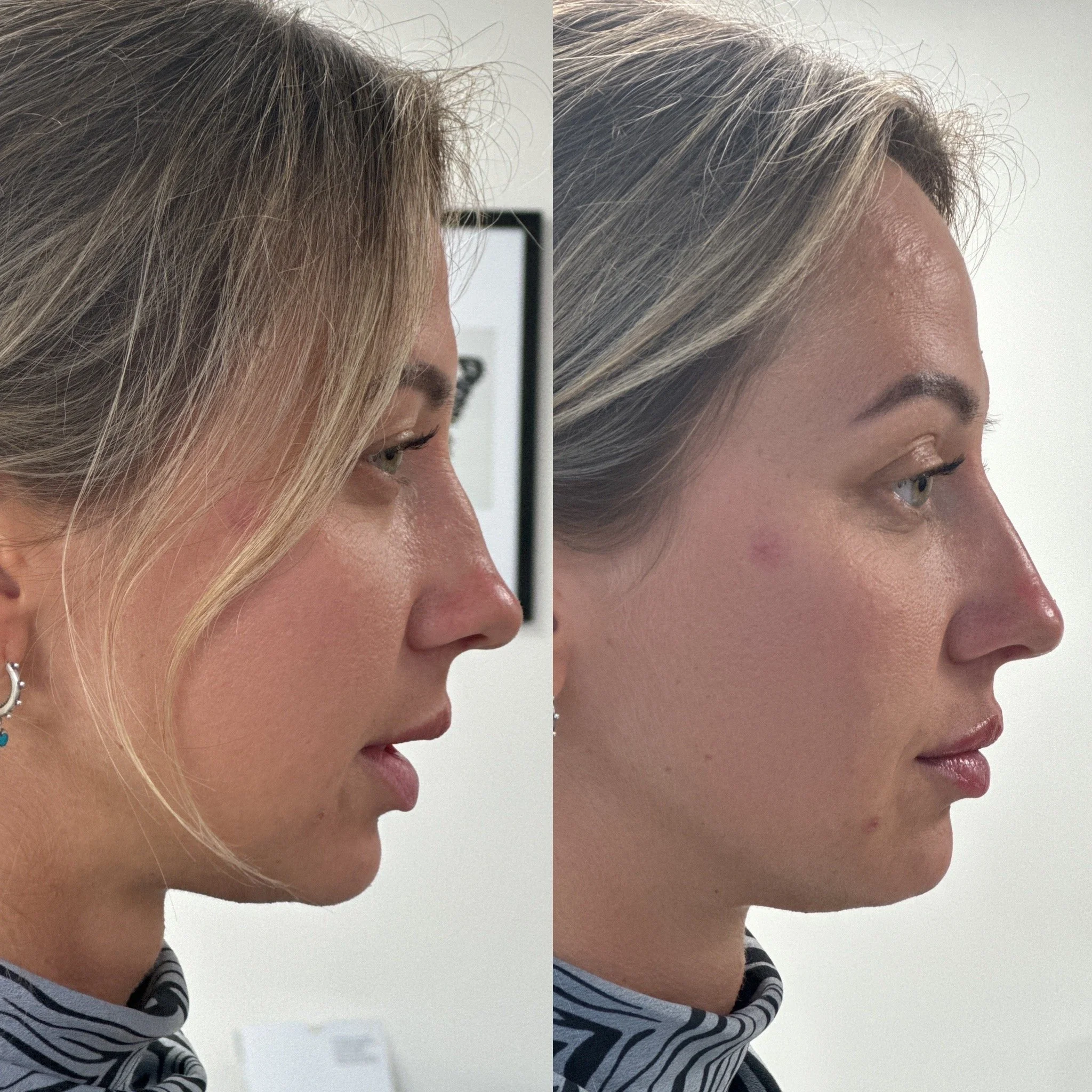 Side profile Before and after close-up photos of a profiling Dermal Filler treatment with Liquid Rhinoplasty, Chin Augmentation & Lip Filler.