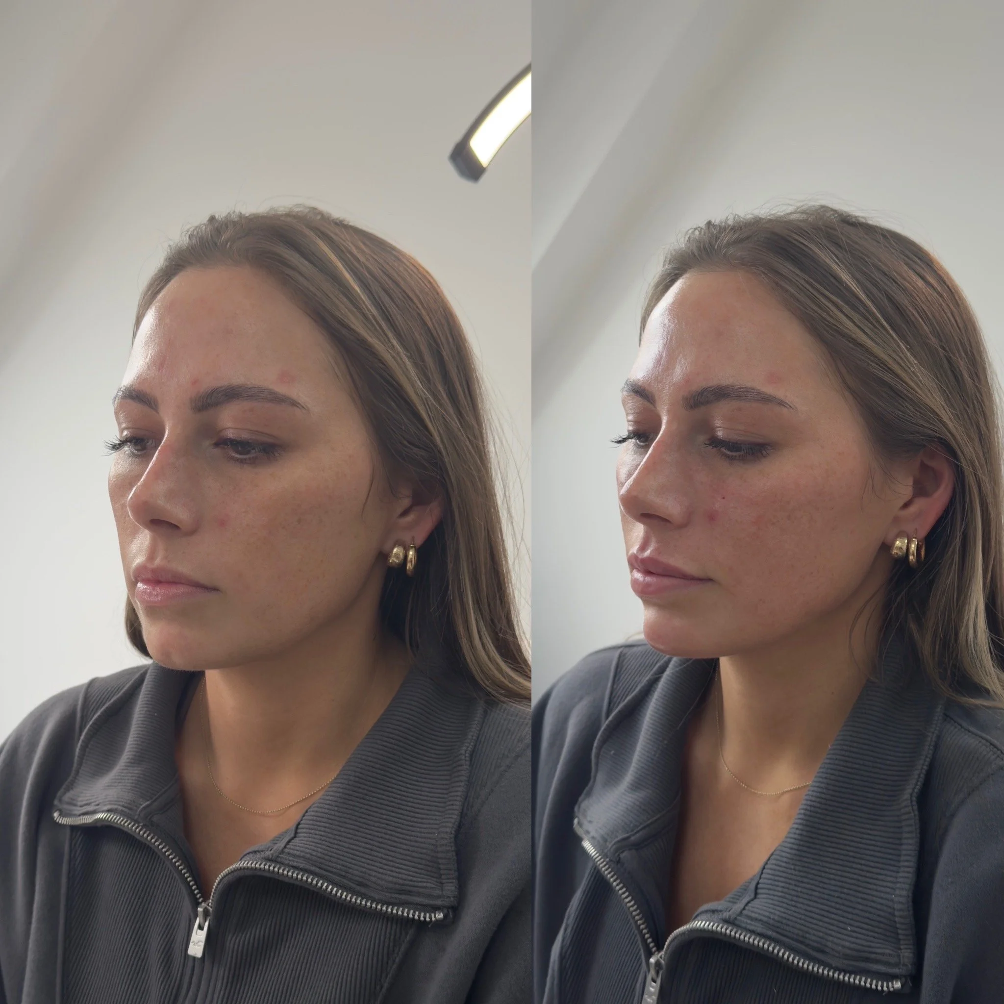 Before and after close-up photos of a beautification Dermal Filler treatment with Cheeks, Chin & Lip Filler using 3mLs for beautification