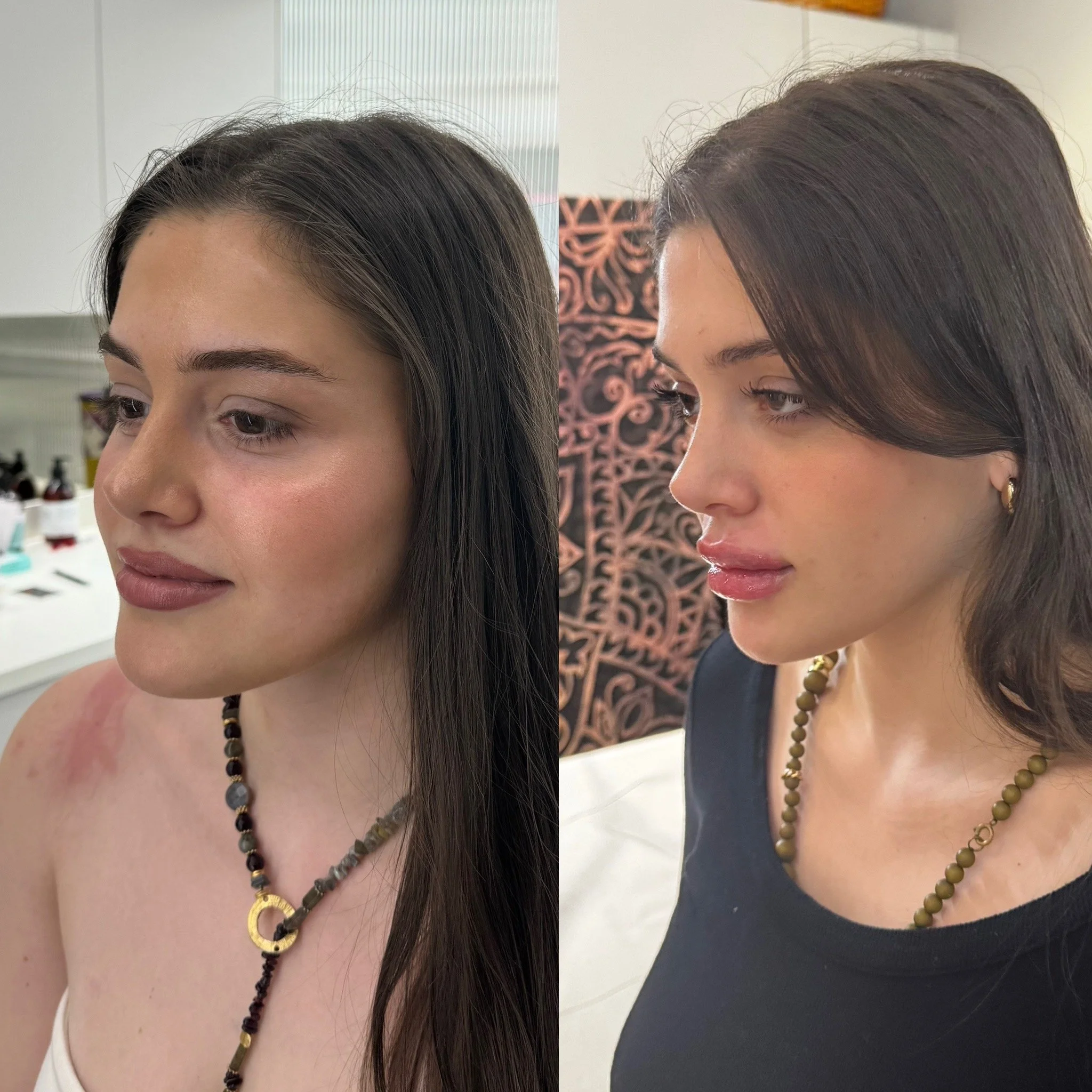 Side-by-side photos of Facial Contouring results of Jaw Slimming with Dermal Fillers in the lips