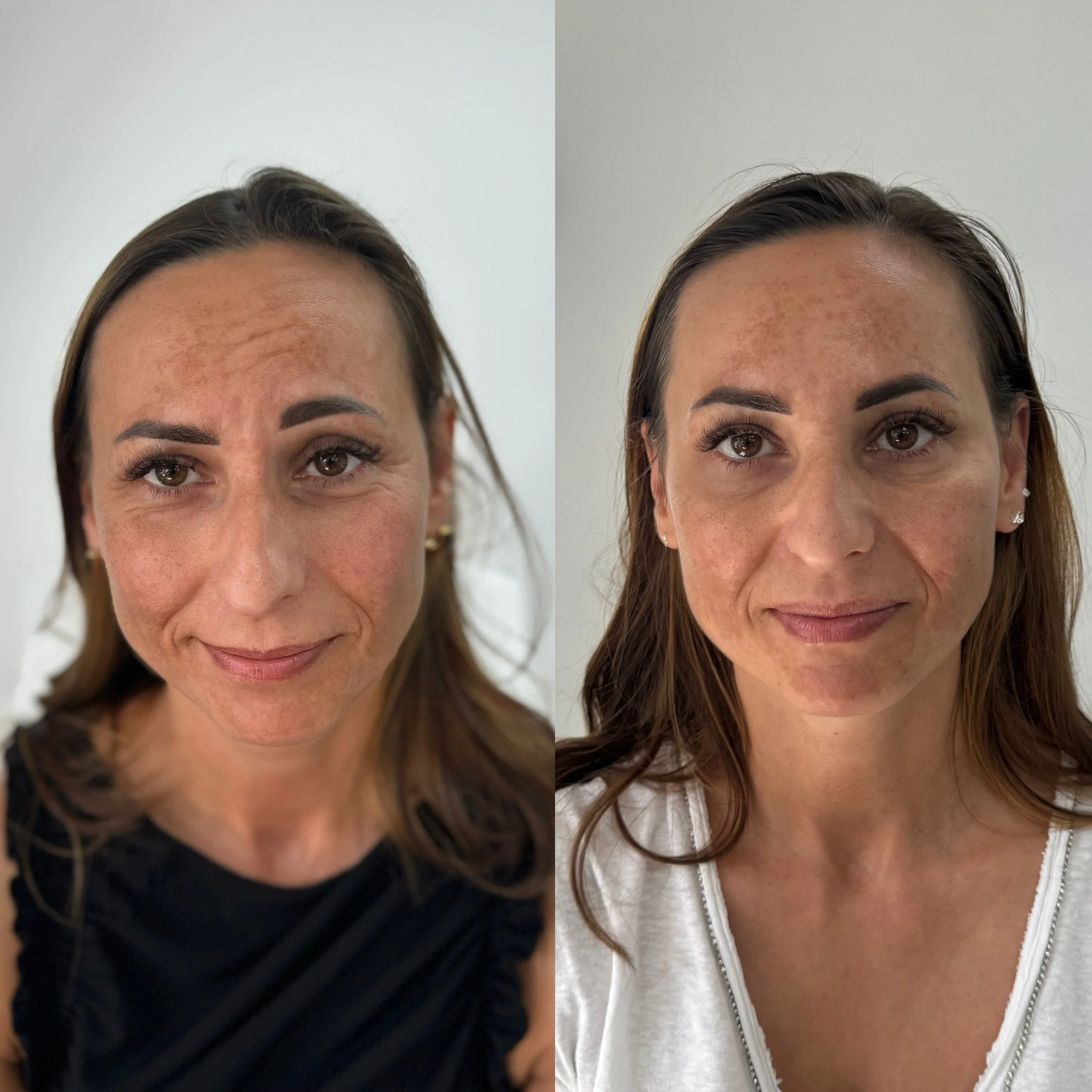 Facial Rejuvenation treatment with Dermal Fillers. 4mL of Dermal filler - Cheek filler, Lip filler, Nose Filler Chin Filler & Facial Contouring.