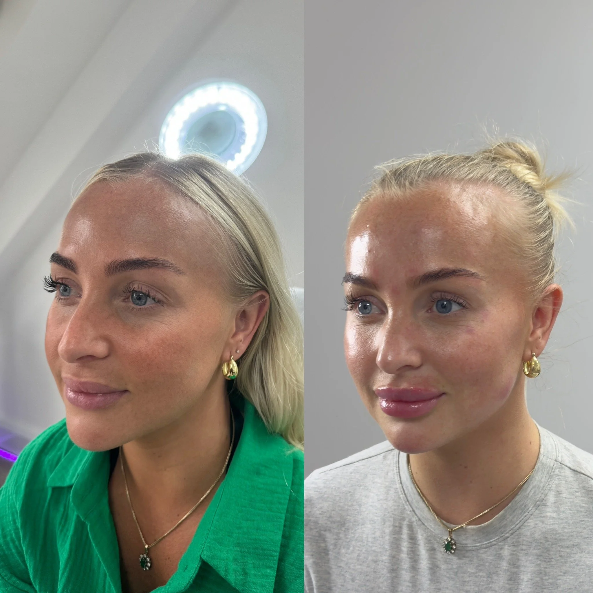 UKALM's trademark Barbie Make-over before and after profiling treatment. Full face transformation with Dermal Filler. The best Dermal Filler treatment & best Aesthetics Clinic in London. Cheek filler, Chin Filler, Liquid Nose Job, Lip Filler.