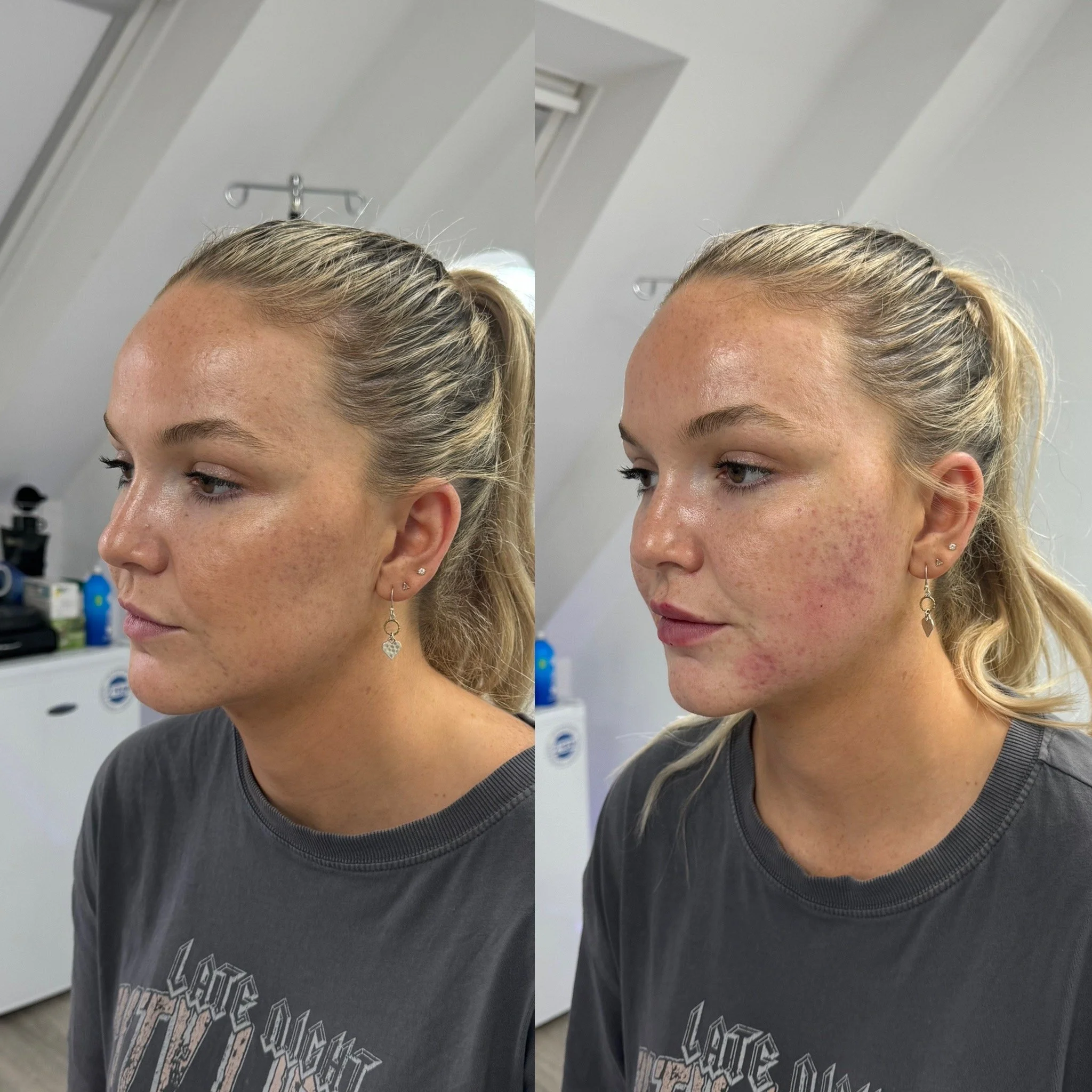 Before and after results of UKALM Acne Scarring & Facial Contouring treatment with Subcision & Dermal Fillers.