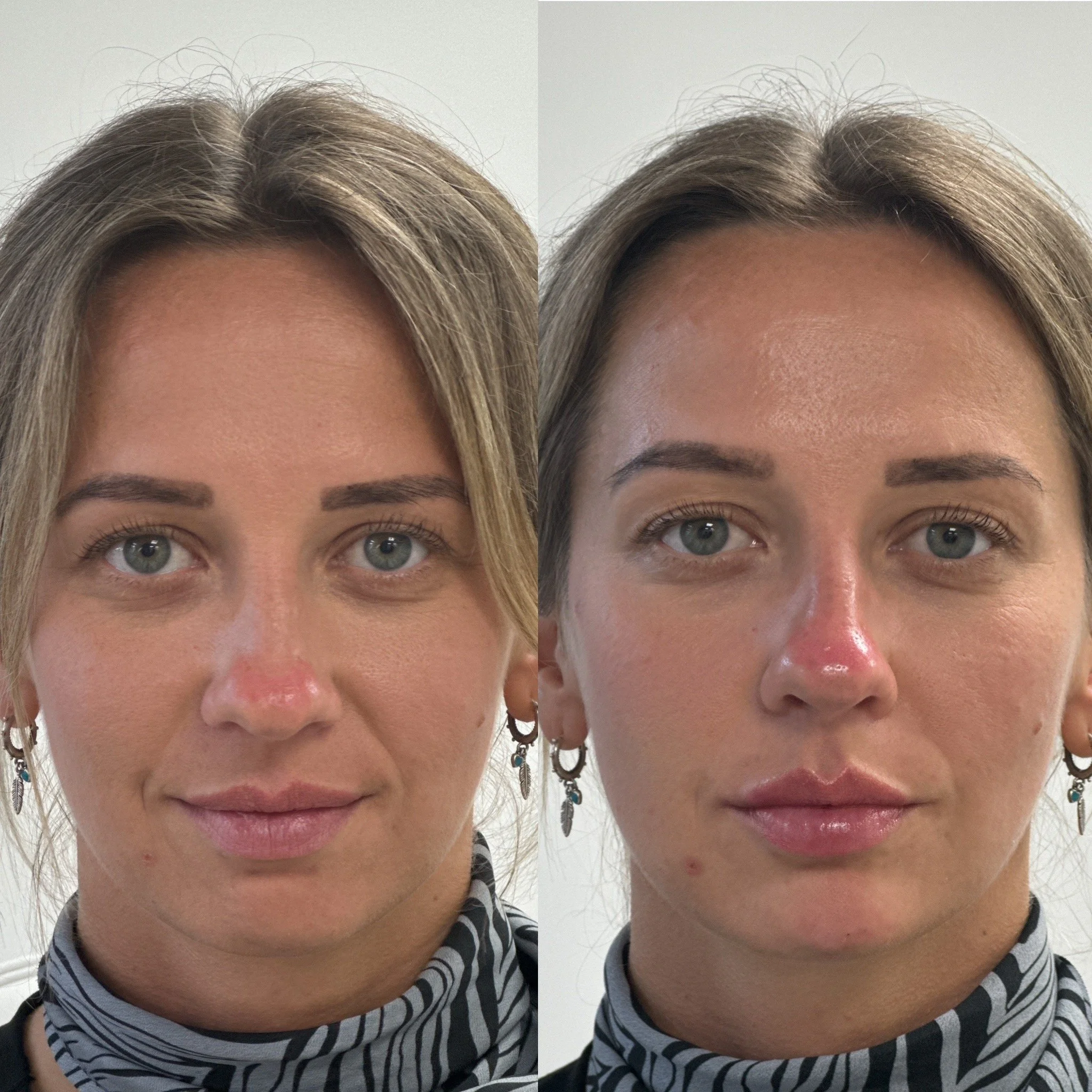 Before and after close-up photos of a profiling Dermal Filler treatment with Liquid Rhinoplasty, Chin Augmentation & Lip Filler.