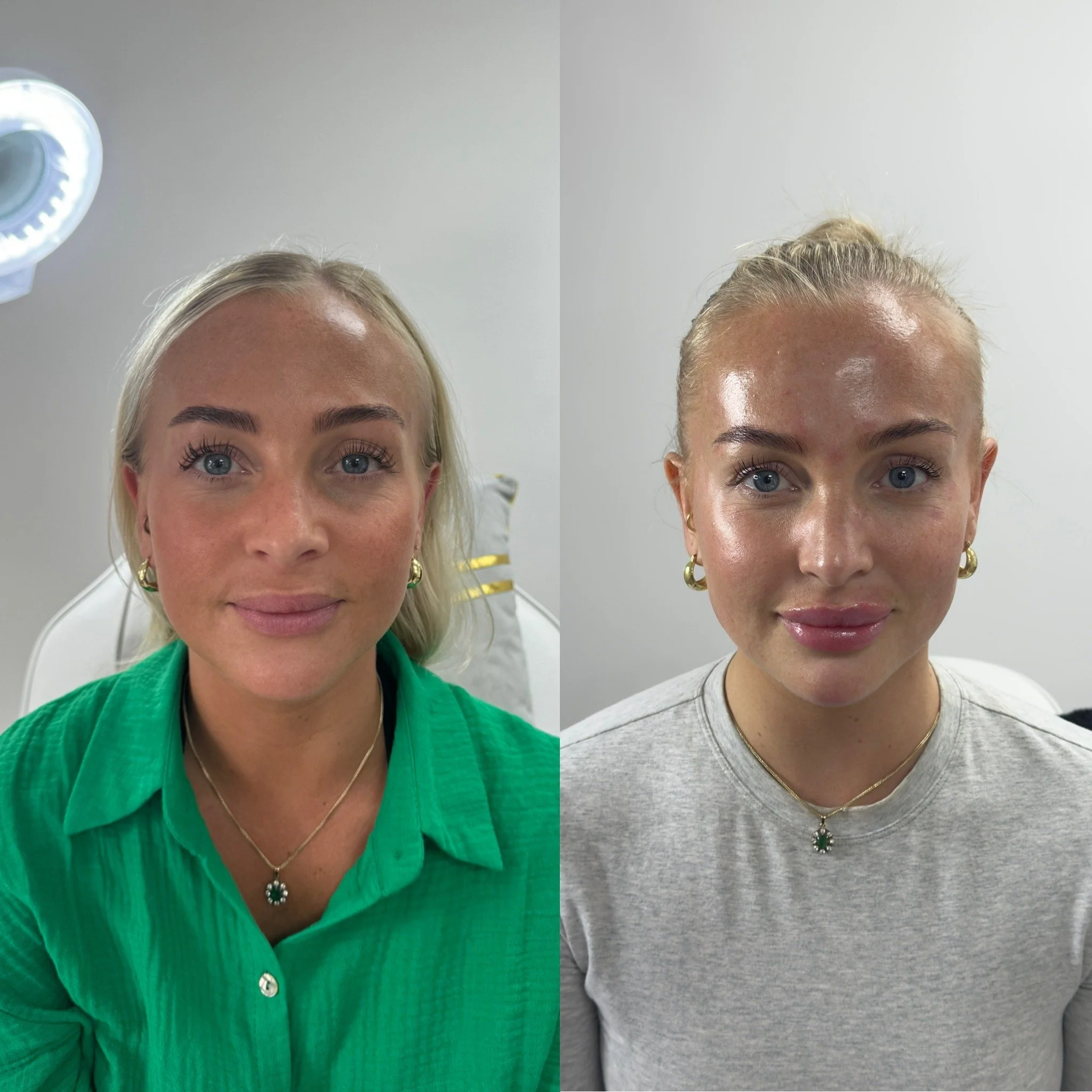 UKALM's trademark Barbie Make-over before and after. Full face transformation with Dermal Filler. The best Dermal Filler treatment & best Aesthetics Clinic in London.