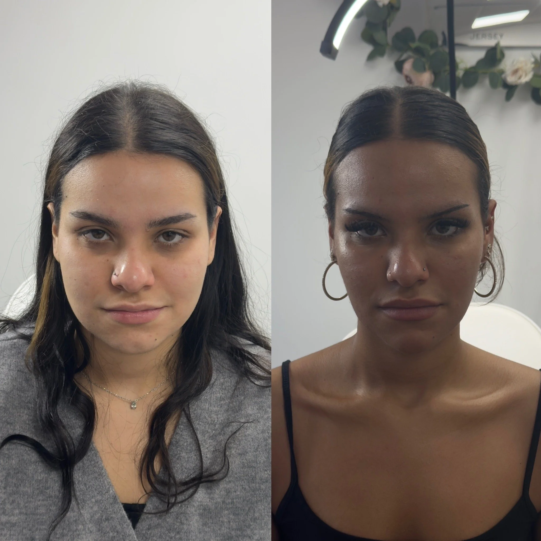 Beautification and Harmonization treatment at UKALM, Dermal Filler experts. The best Dermal Filler treatment & best Aesthetics Clinic in London.