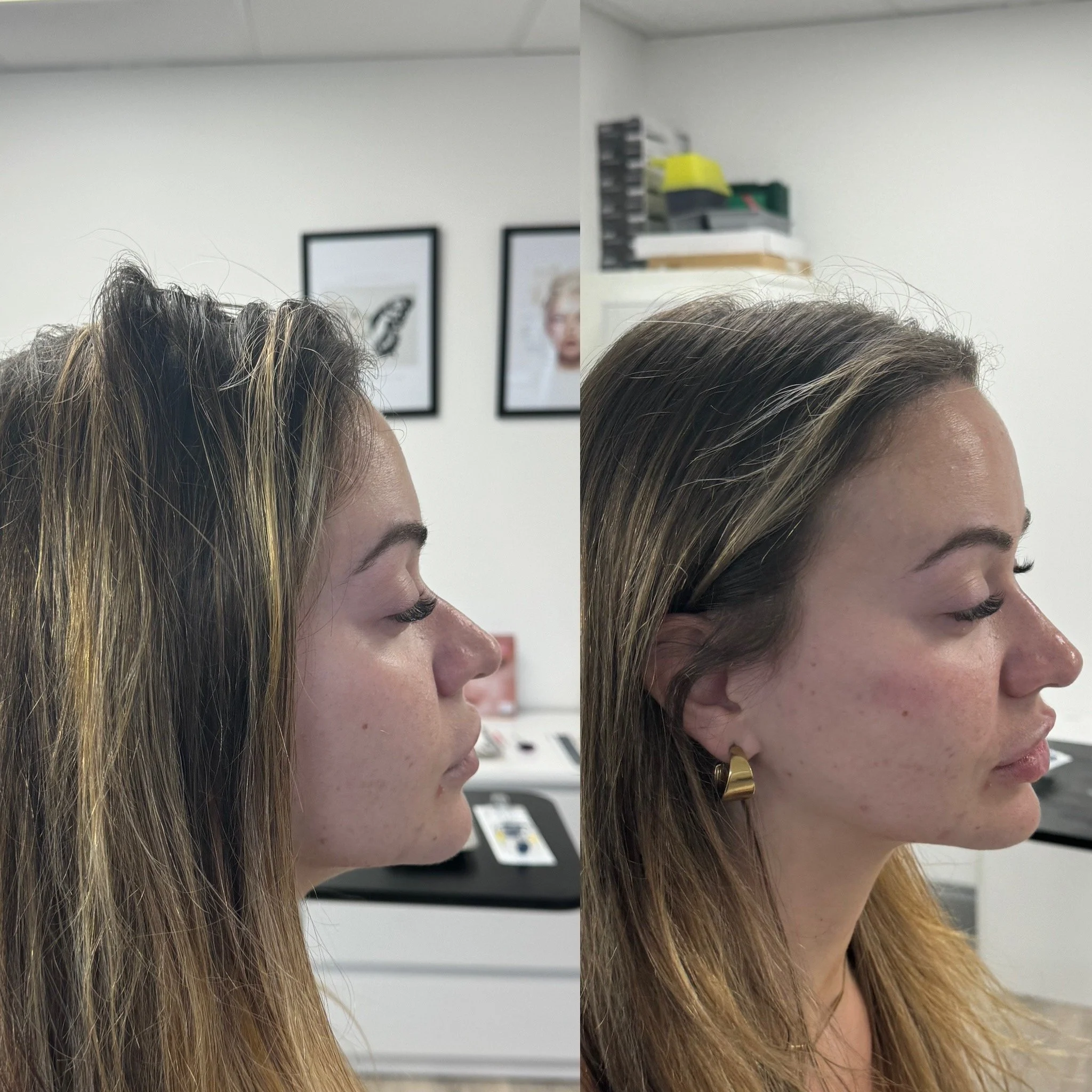 Side profile view of 3mL Dermal Filler Treatment for Chin Filler & Profiling at UKALM