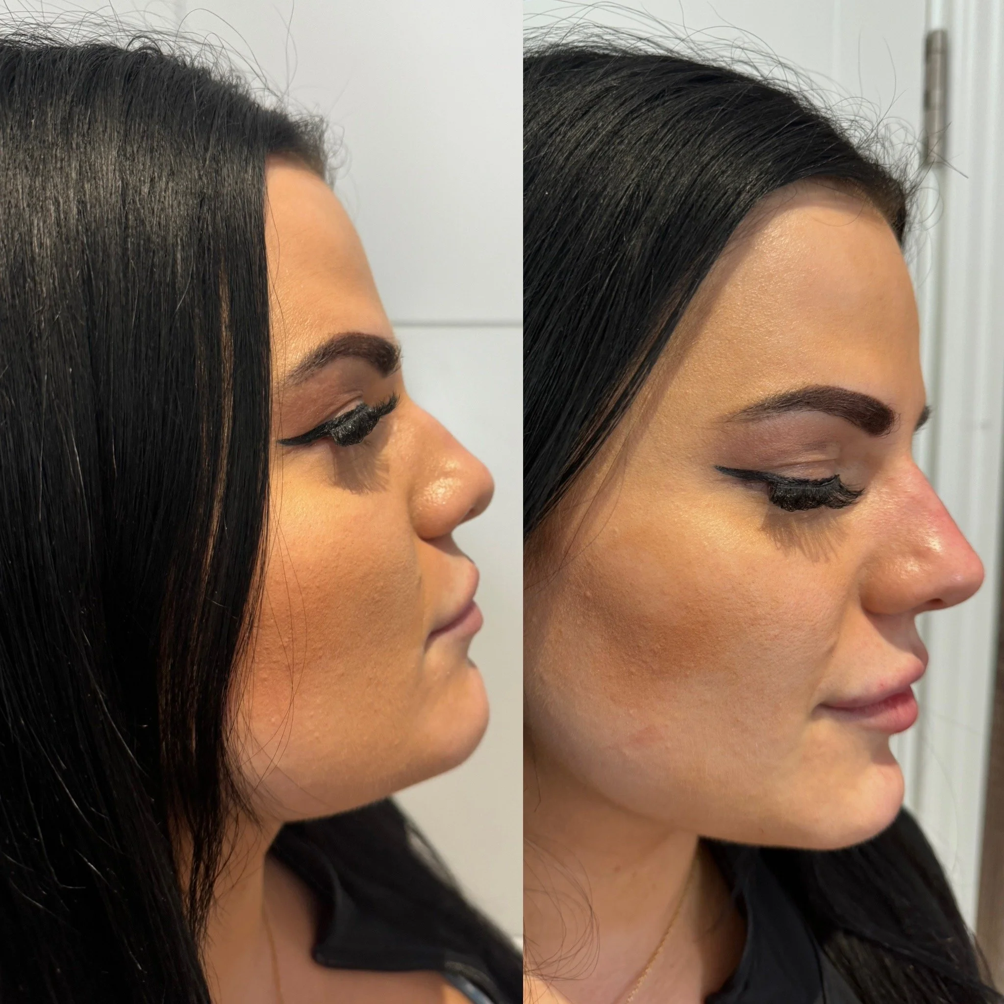 Side View of Beautification with Dermal Filler of the Nose & Chin in addition to Lip filler to feminise a masculine face. 3mLs of Dermal Filler package