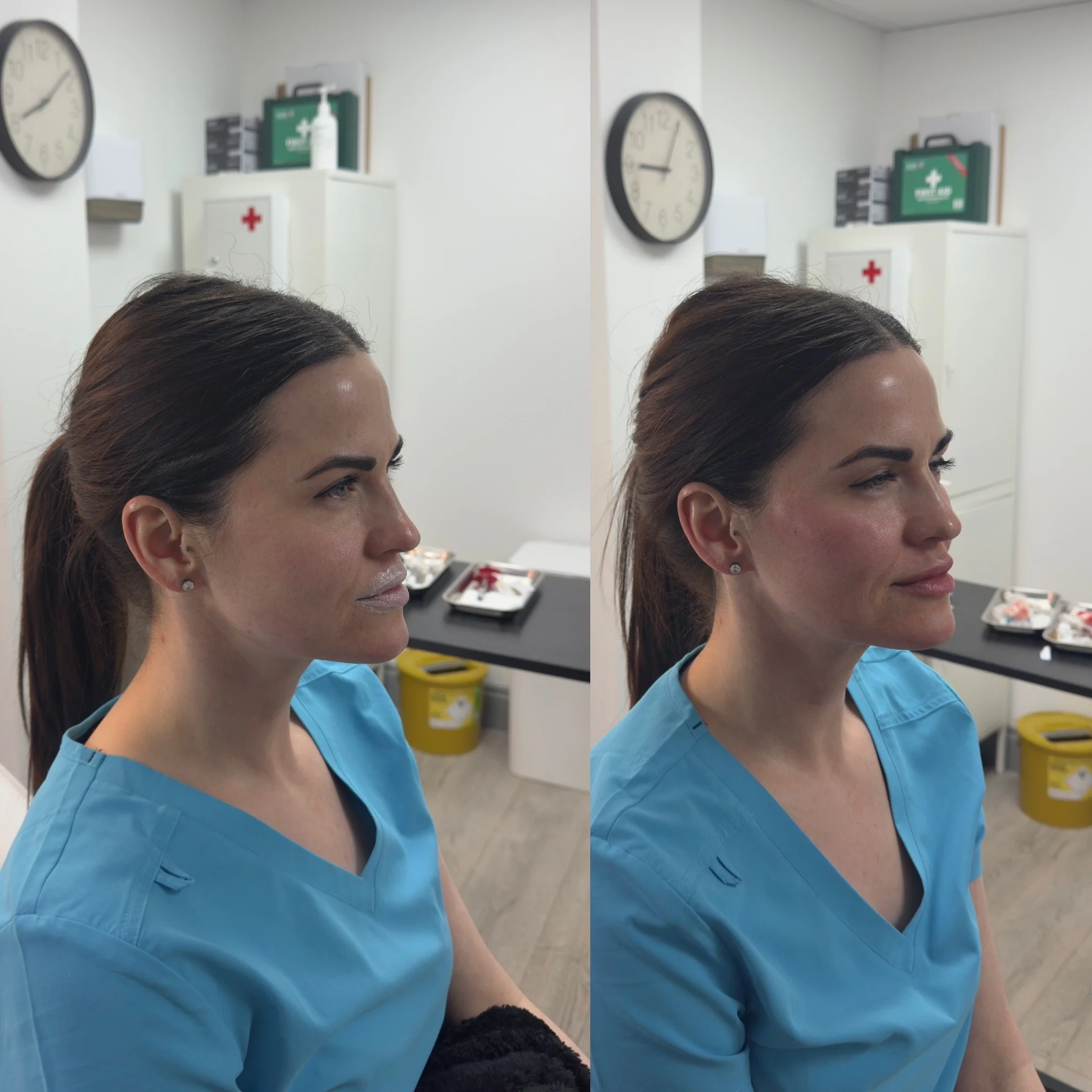 Beautification treatment with Dermal Fillers. 4mL of Dermal filler - Cheek filler, Lip filler, Chin Filler & Facial Contouring.