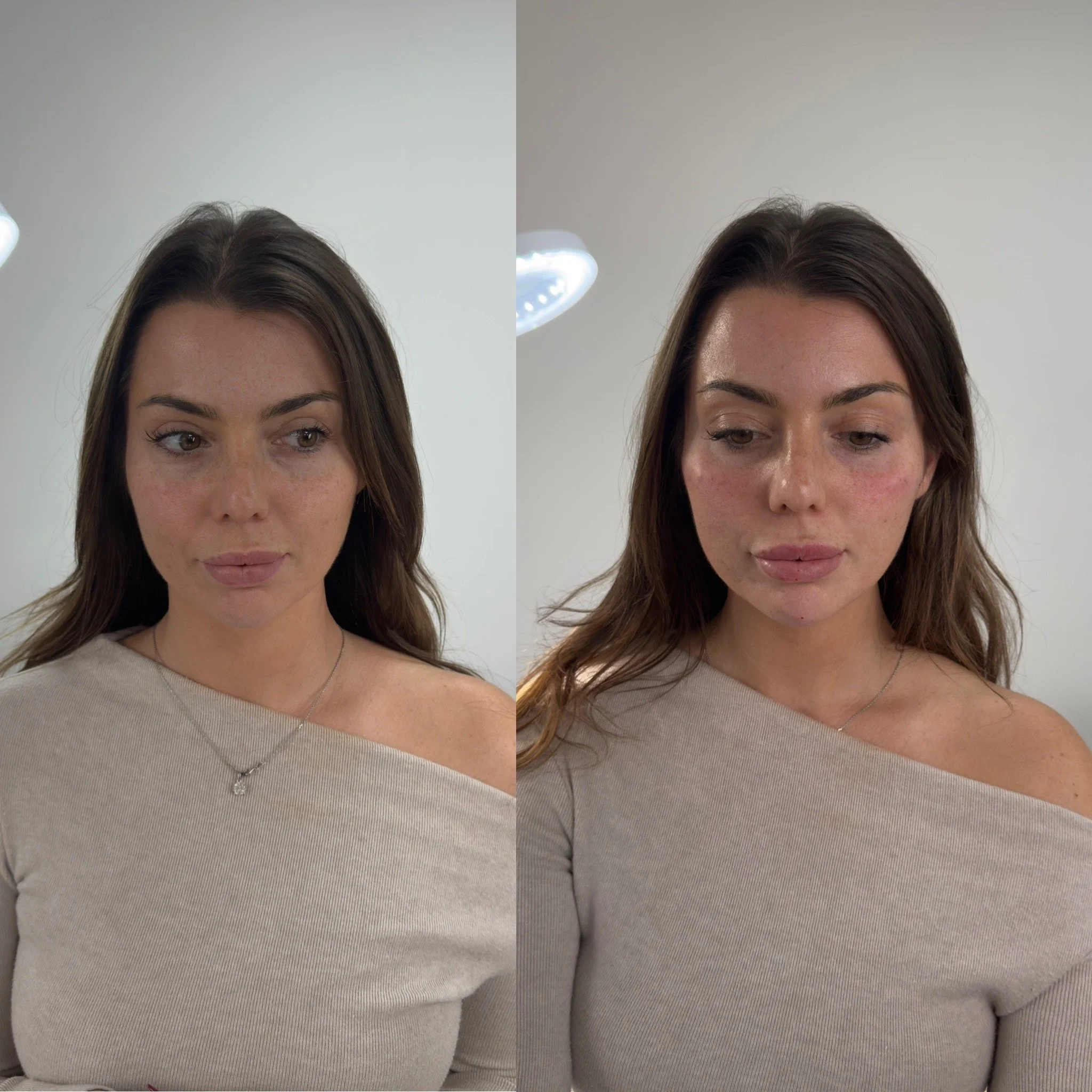 Facial Profiling results of 3mLs Dermal filler to balance the cheeks & profile the lips, chin & nose