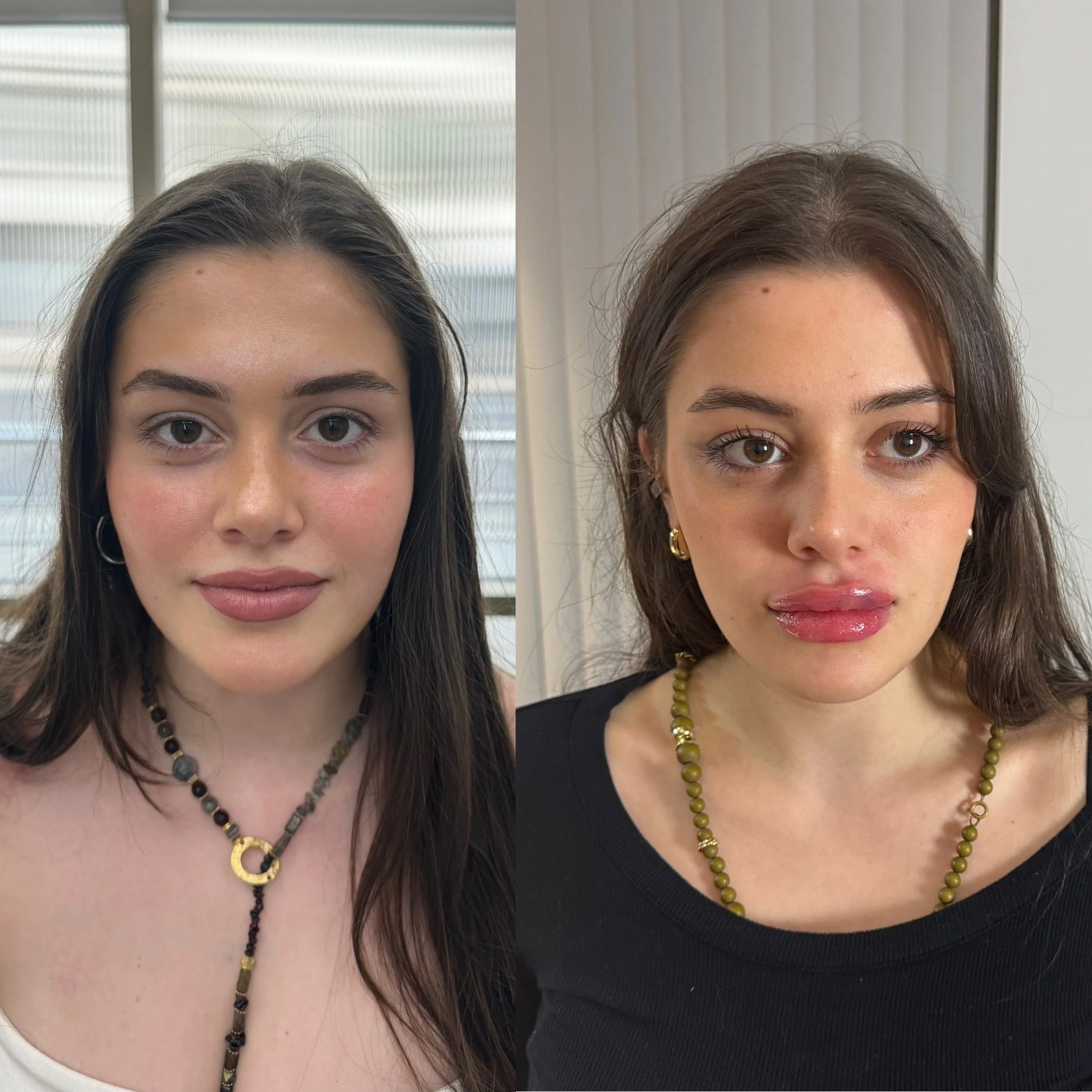 Facial Contouring results of Jaw Slimming with Dermal Fillers in the lips
