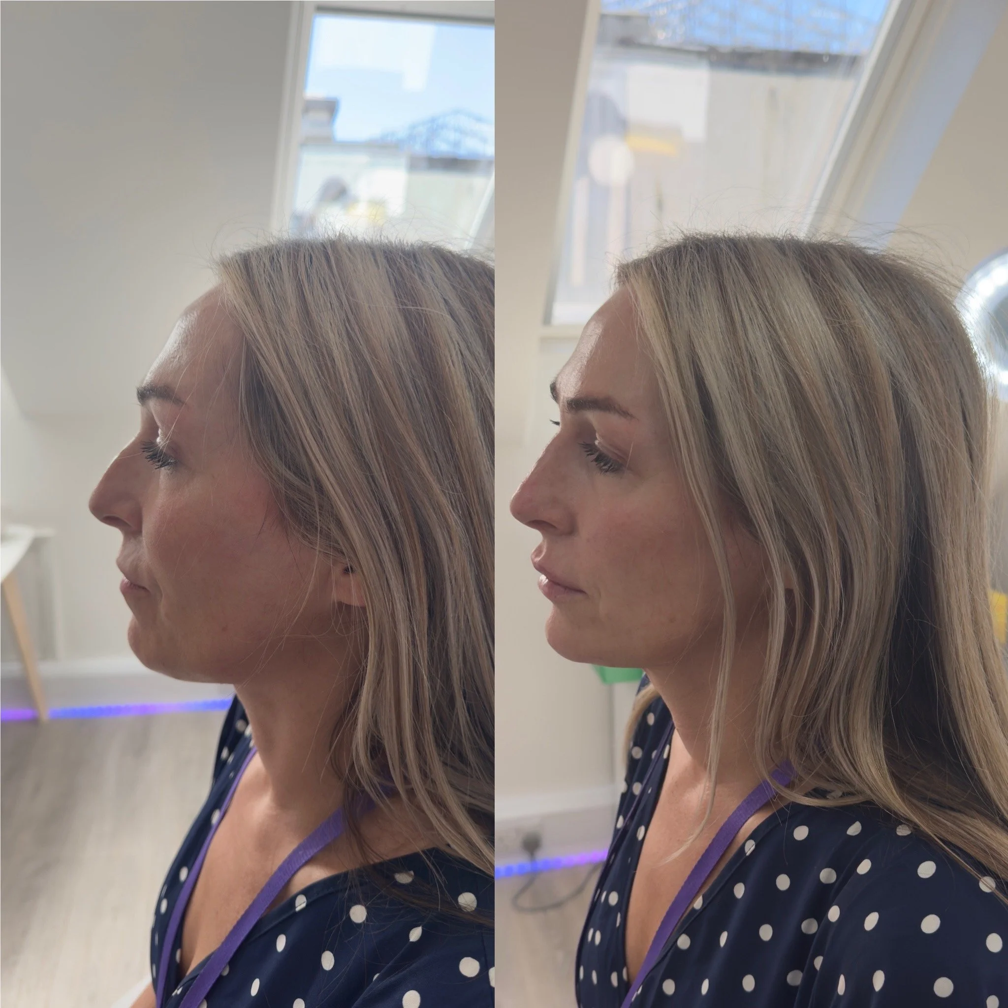 Side view Before & After of 4mL Beautification Treatment in a woman at UKALM Clinics using only 3.5mLs of Dermal Filler for sculpted aesthetic with cheek, chin, nose & Lip filler.