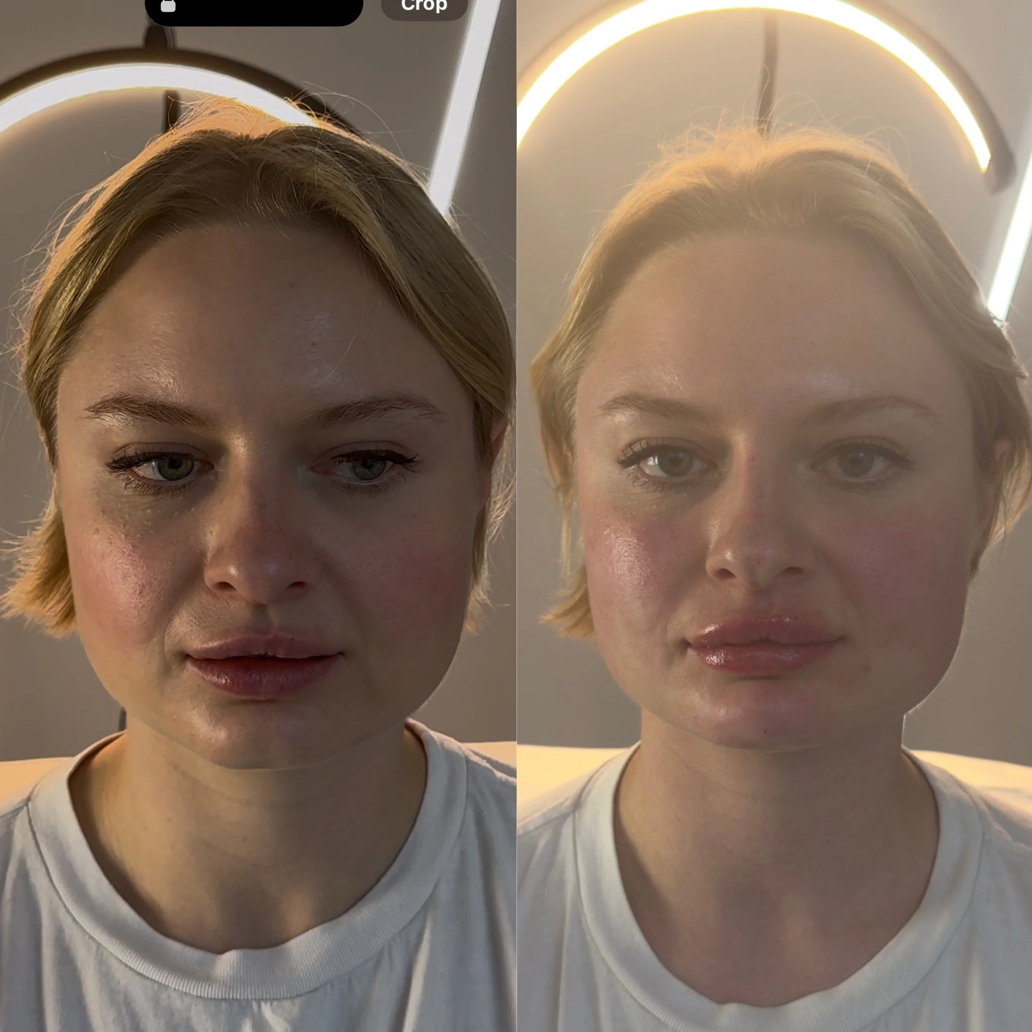Before and after close-up photos of a facial contouring Dermal Filler treatment with Cheeks, Chin & Lip Filler using 3mLs for beautification.