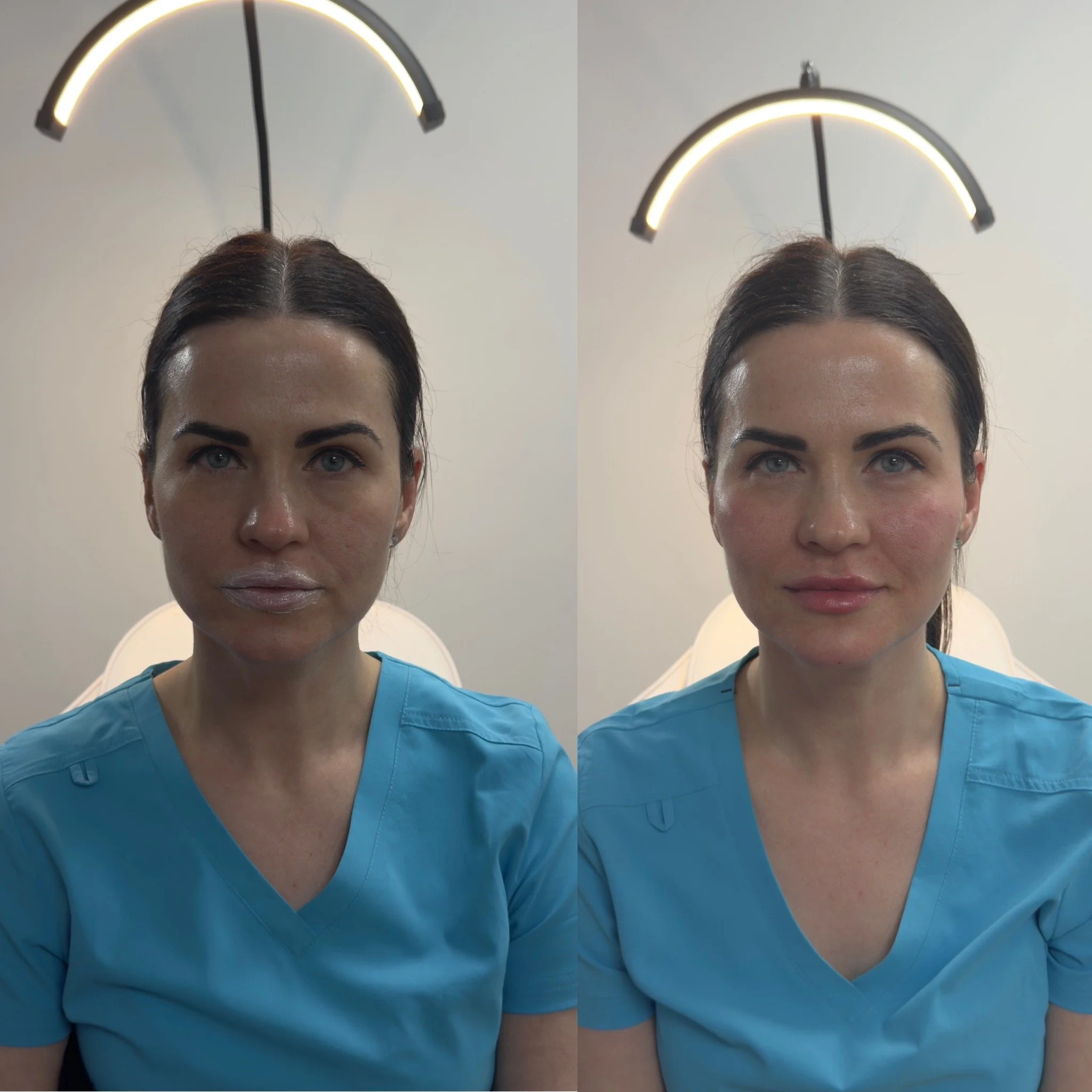 Beautification treatment with Dermal Fillers. 4mL of Dermal filler - Cheek filler, Lip filler, Chin Filler & Facial Contouring.