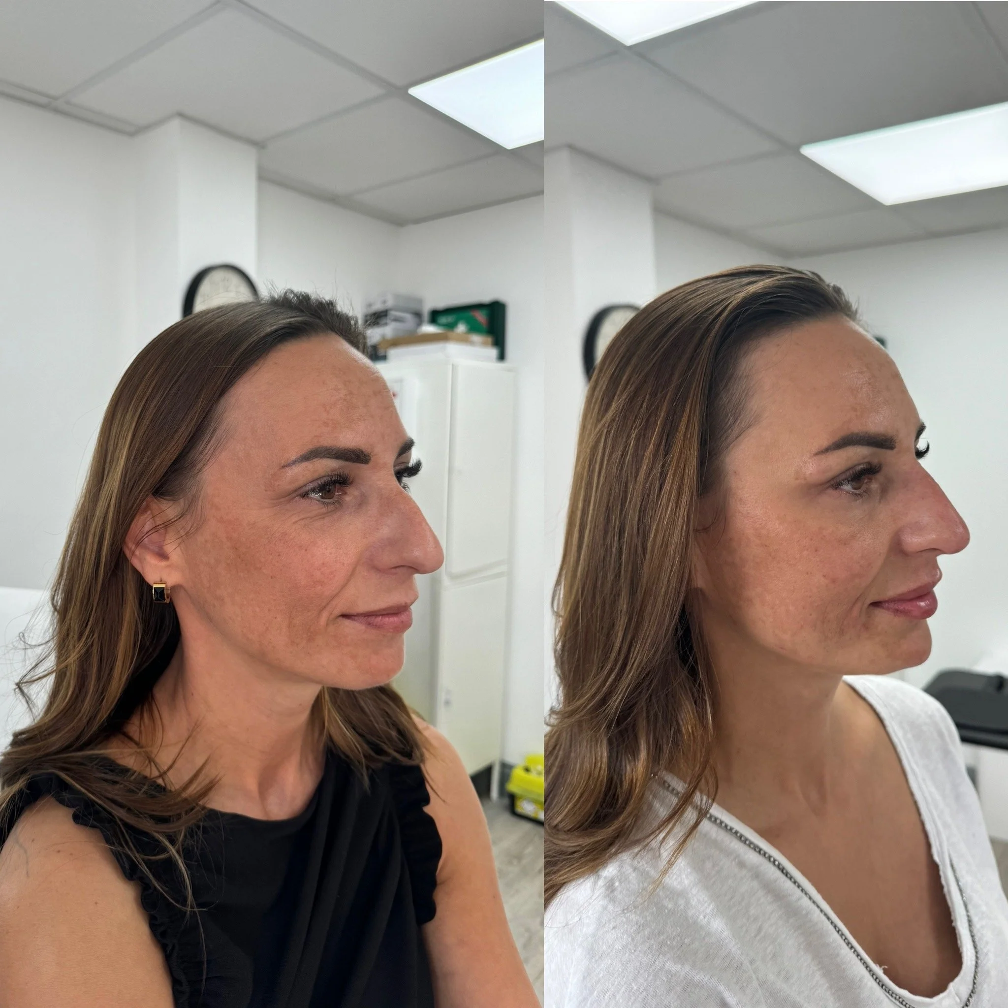 Profiling view of Facial Rejuvenation treatment with Dermal Fillers. 4mL of Dermal filler - Cheek filler, Lip filler, Nose Filler Chin Filler & Facial Contouring.