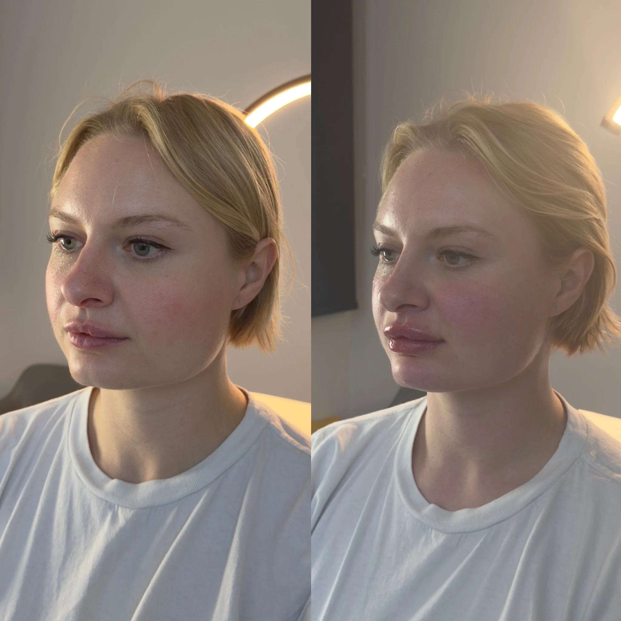 Side profile view Before and after close-up photos of a facial contouring Dermal Filler treatment with Cheeks, Chin & Lip Filler using 3mLs for beautification.